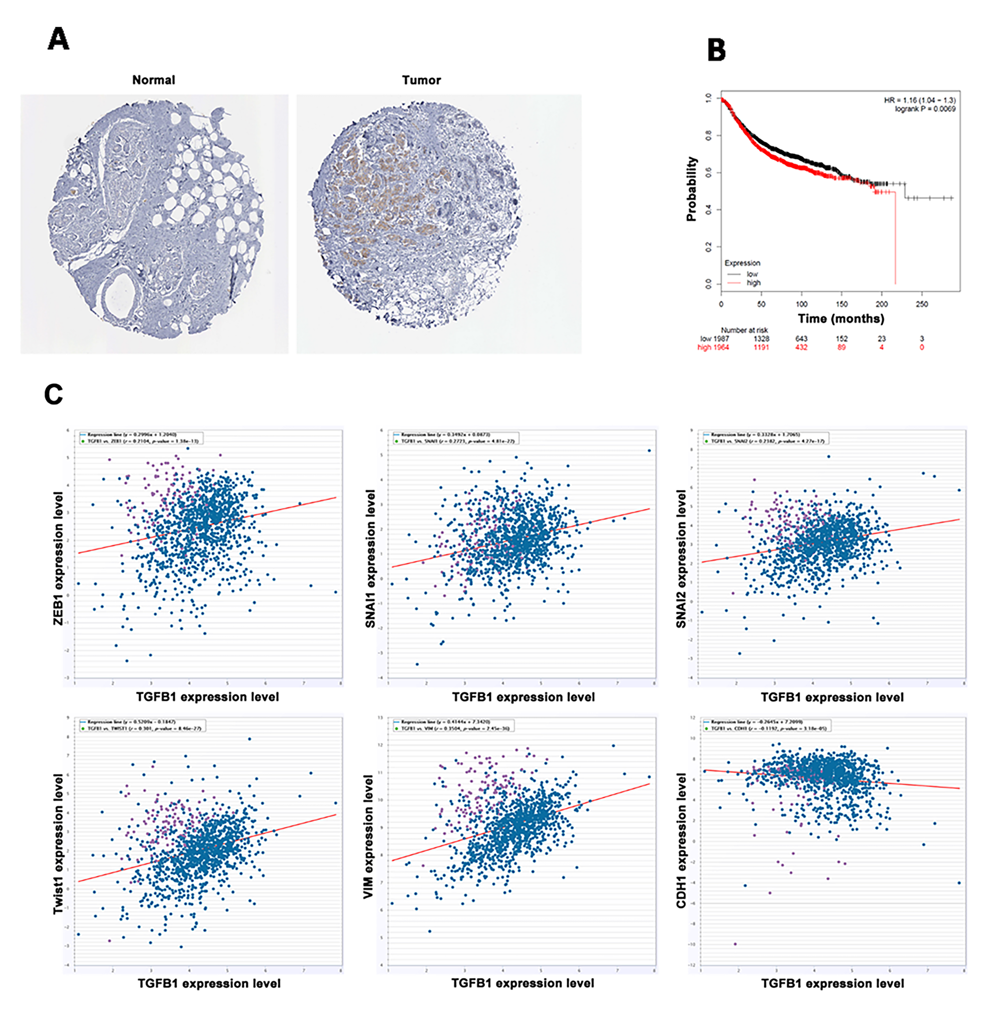 TGF-β1 was highly expressed in breast cancer and predicted poor prognosis