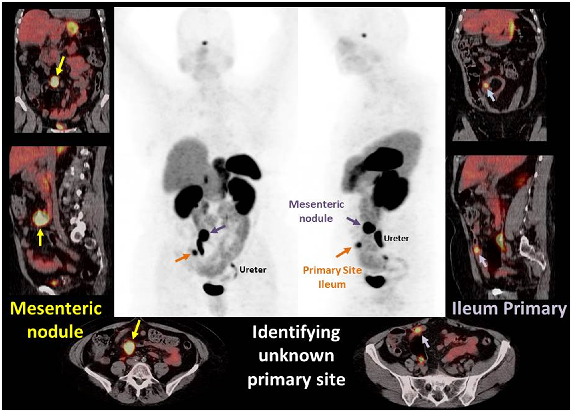 Images demonstrate PET MIP images and fused PET/CT axial, sagittal, and coronal images of a case example of gallium-68 DOTATATE identifying unknown primary site
