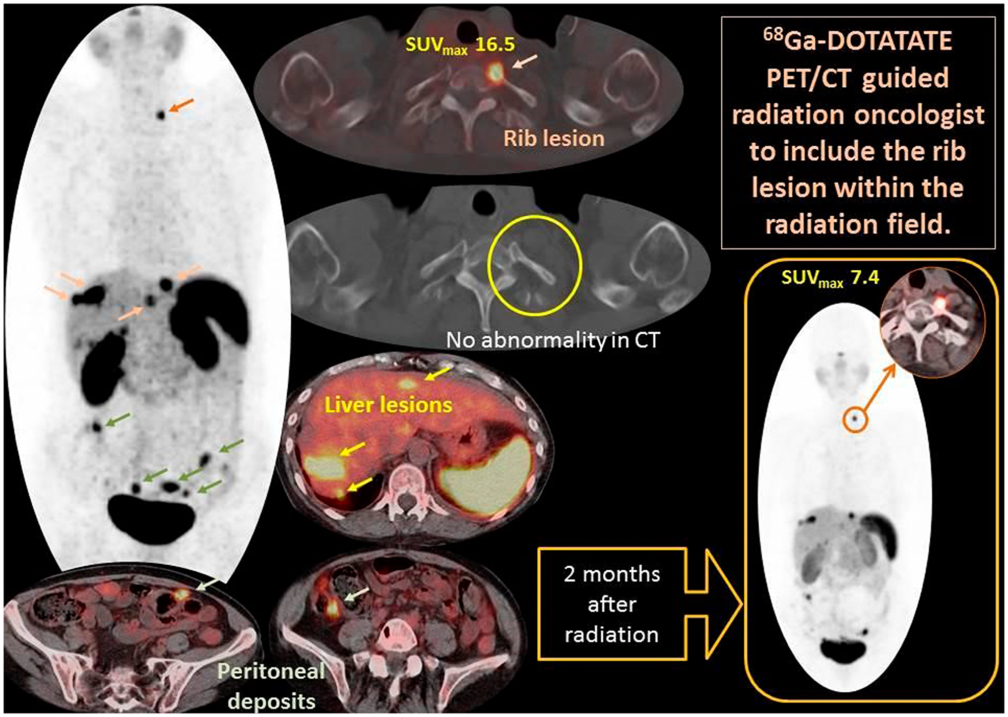 Demonstrates PET MIP image (Central) and fused PET/CT axial images of a case example of gallium- 68 DOTATATE that influenced and guided management