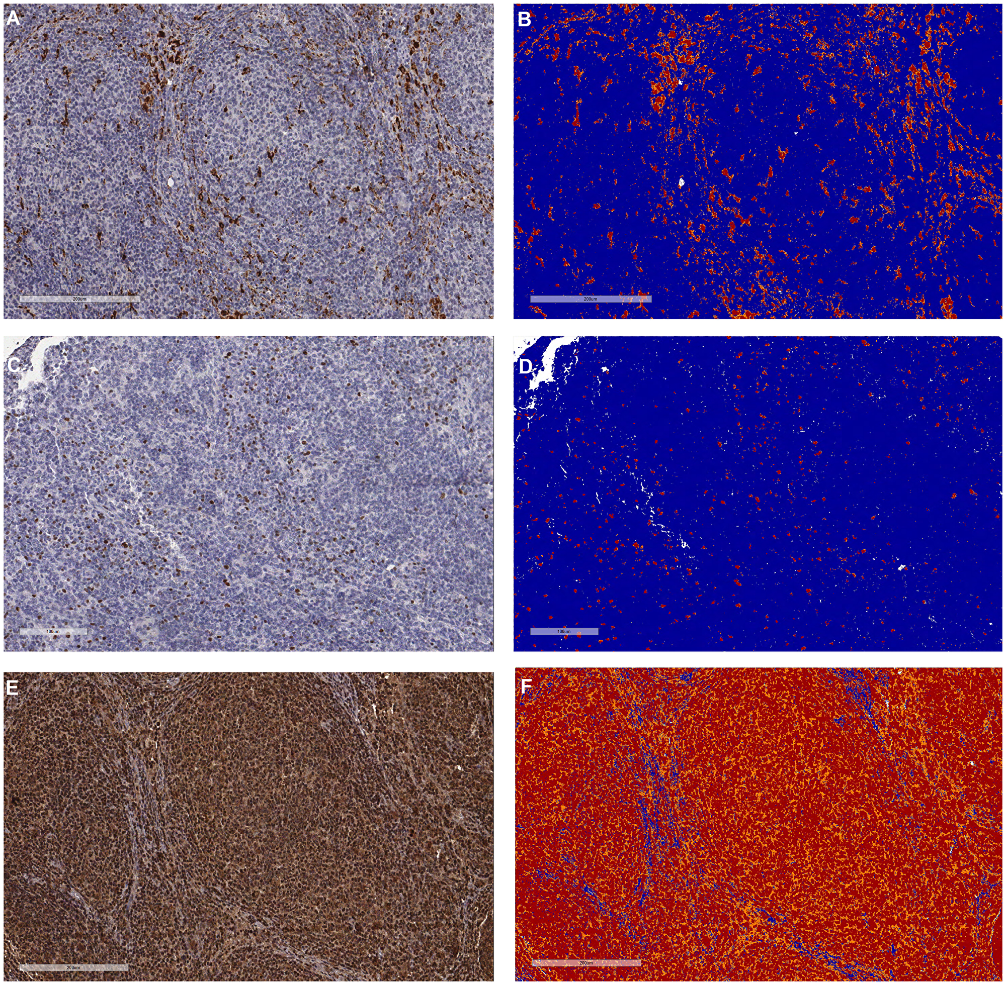 Representative pictures of the tumor microenvironment assessments by immunohistochemistry in follicular lymphoma