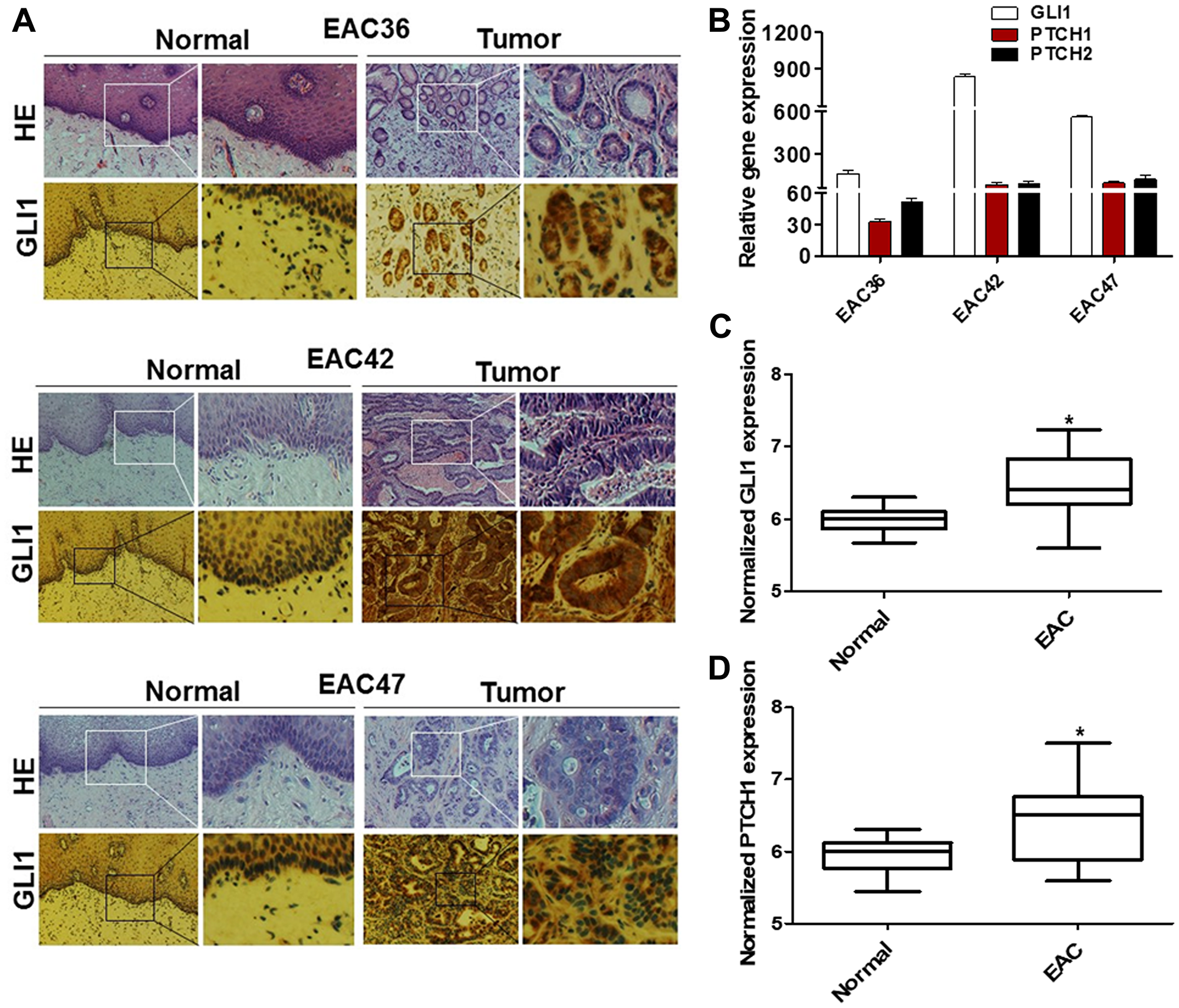 GLI1 activity is increased in human EAC tumors