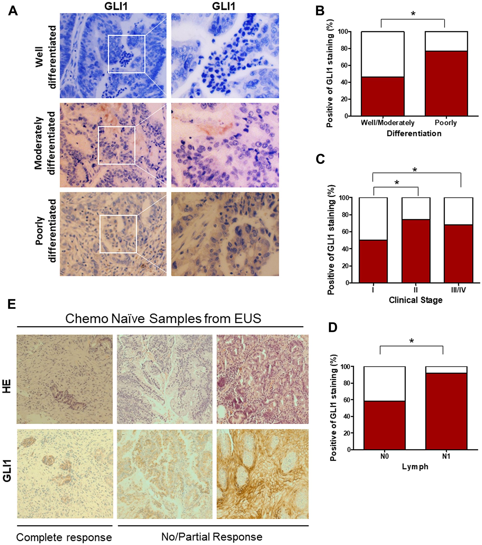 Elevated GLI1 activity is associated with the differentiation state and clinical stage of EAC, drives resistance to the chemotherapy