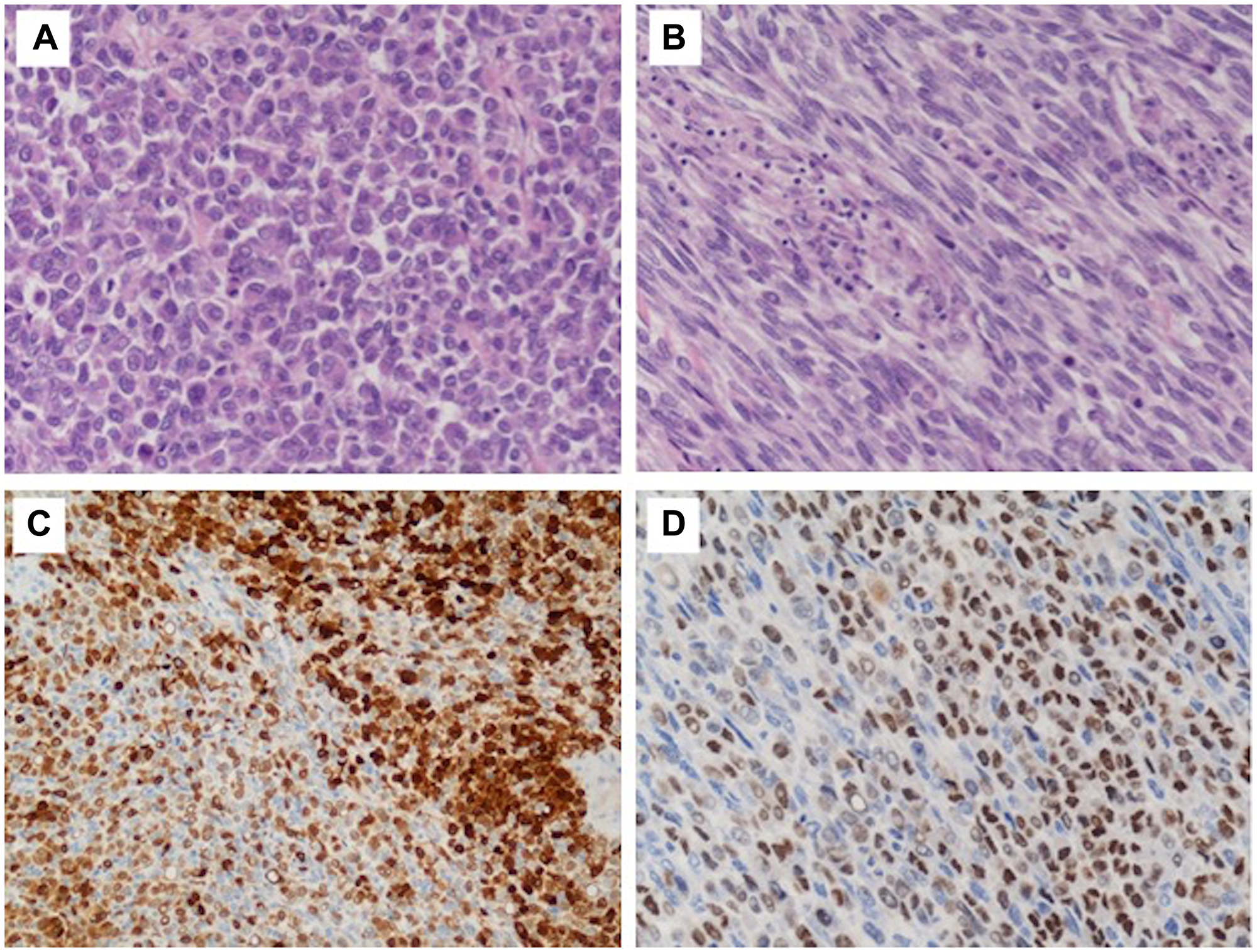 Histological findings of the tumor