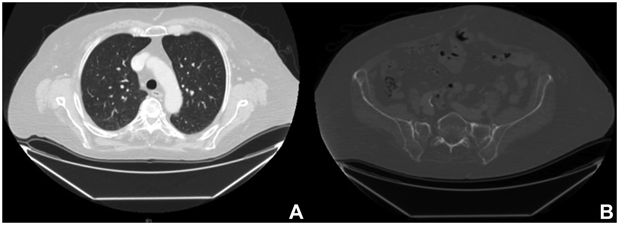 Radiological images after combined targeted therapy