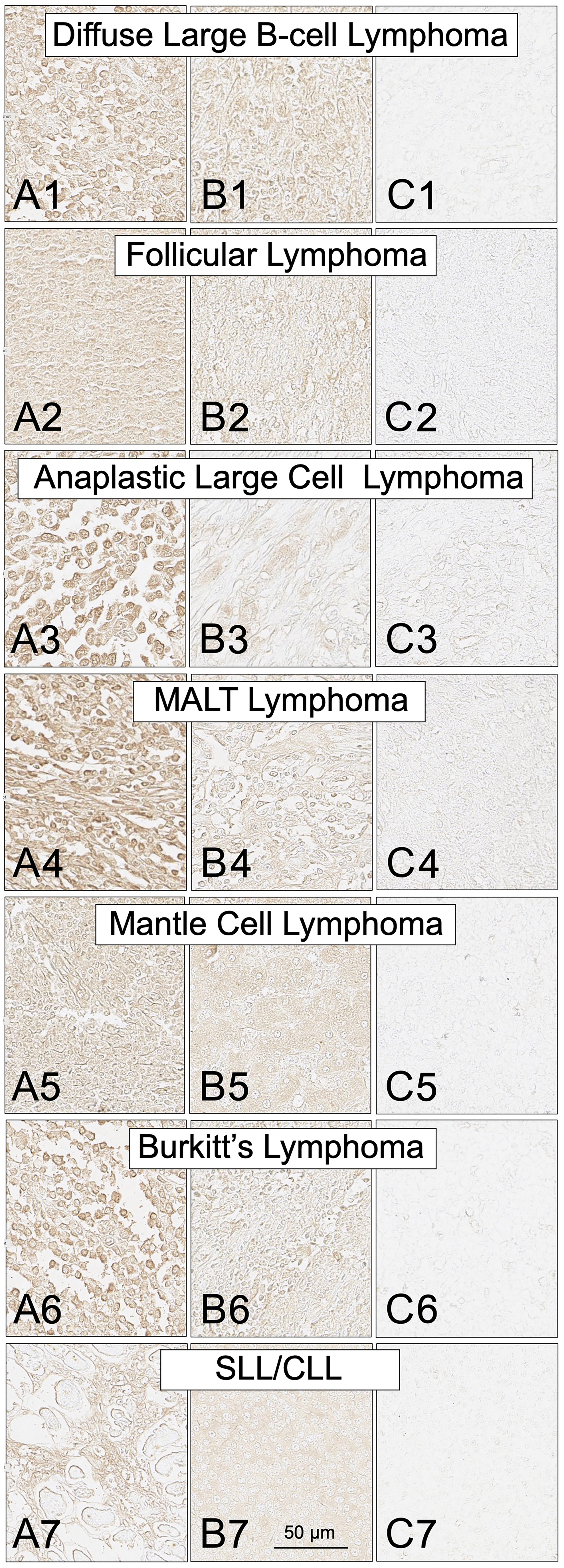 SH7129 staining of tumor biopsy sections from seven subtypes of non-Hodgkin’s lymphoma