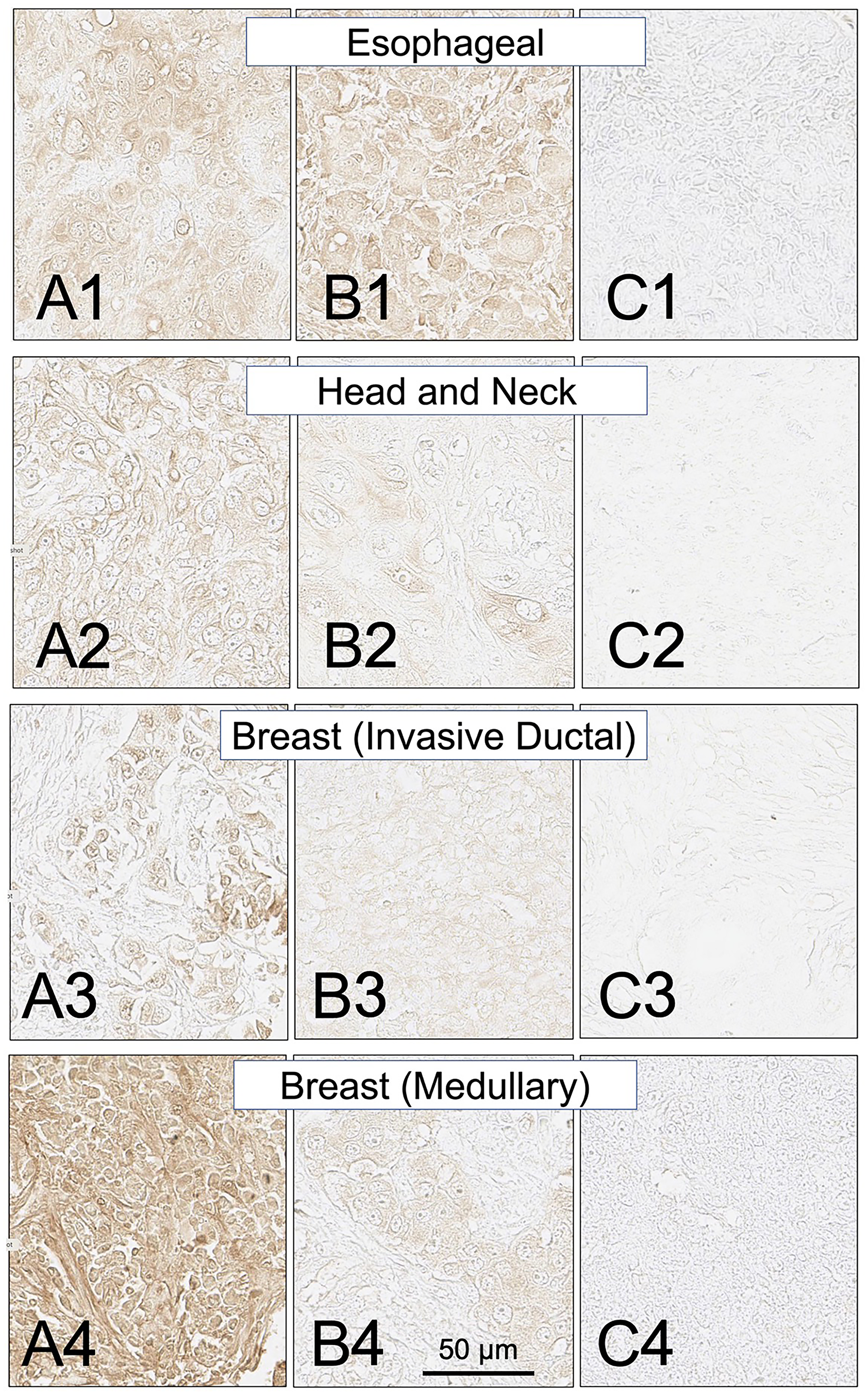 SH7129 stained sections of representative esophageal, head and neck, and breast (invasive ductal and medullary carcinoma) cancers expressing HLA-DRs targeted by SH7139