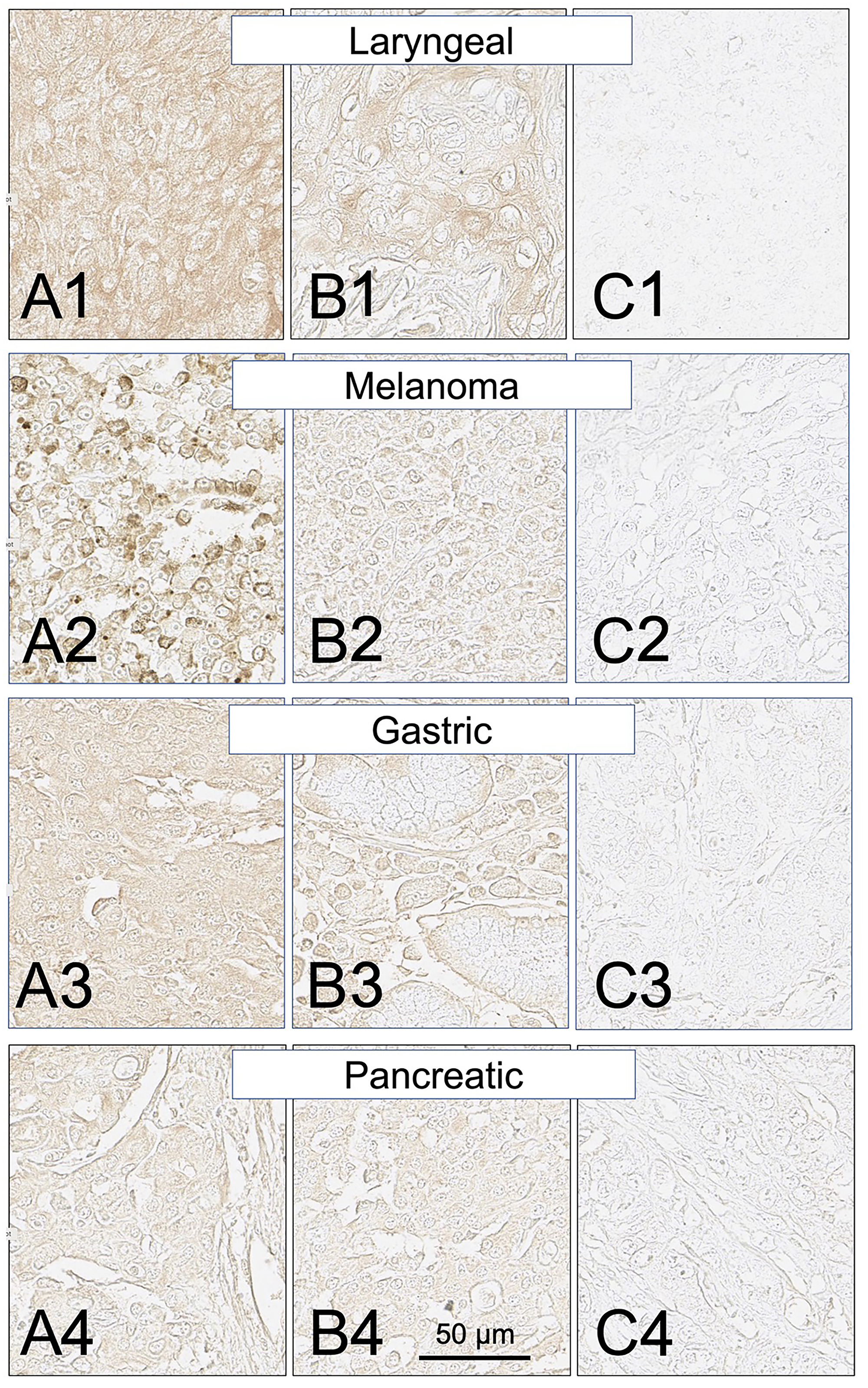 SH7129 stained sections of representative laryngeal, melanoma, gastric, and pancreatic cancers expressing HLA-DRs targeted by SH7139