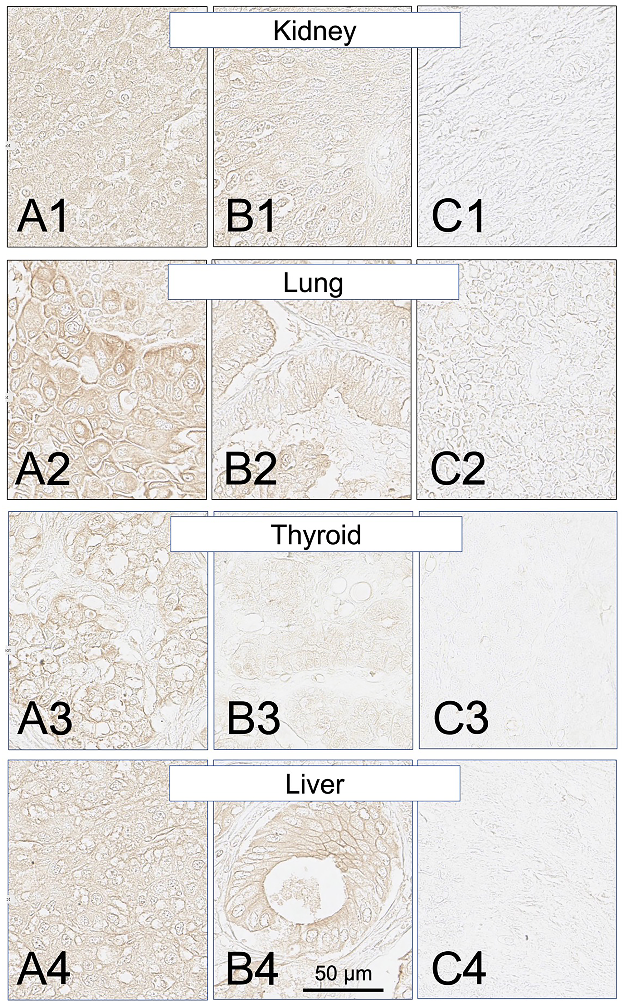 SH7129 stained sections of representative kidney, lung, thyroid and liver cancers expressing HLA-DRs targeted by SH7139
