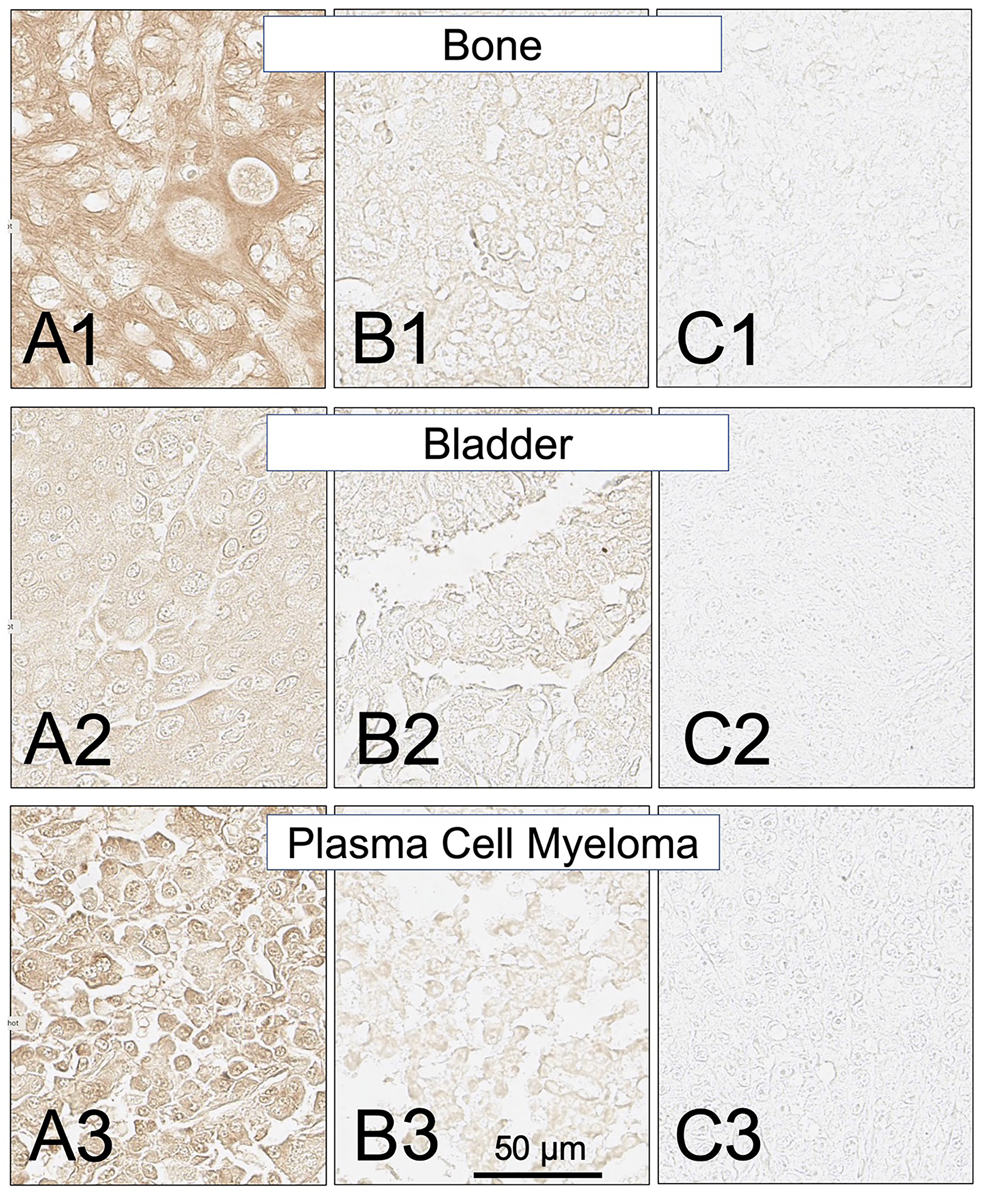 SH7129 stained sections of representative bone, bladder and plasma cell myeloma cancers expressing HLA-DRs targeted by SH7139