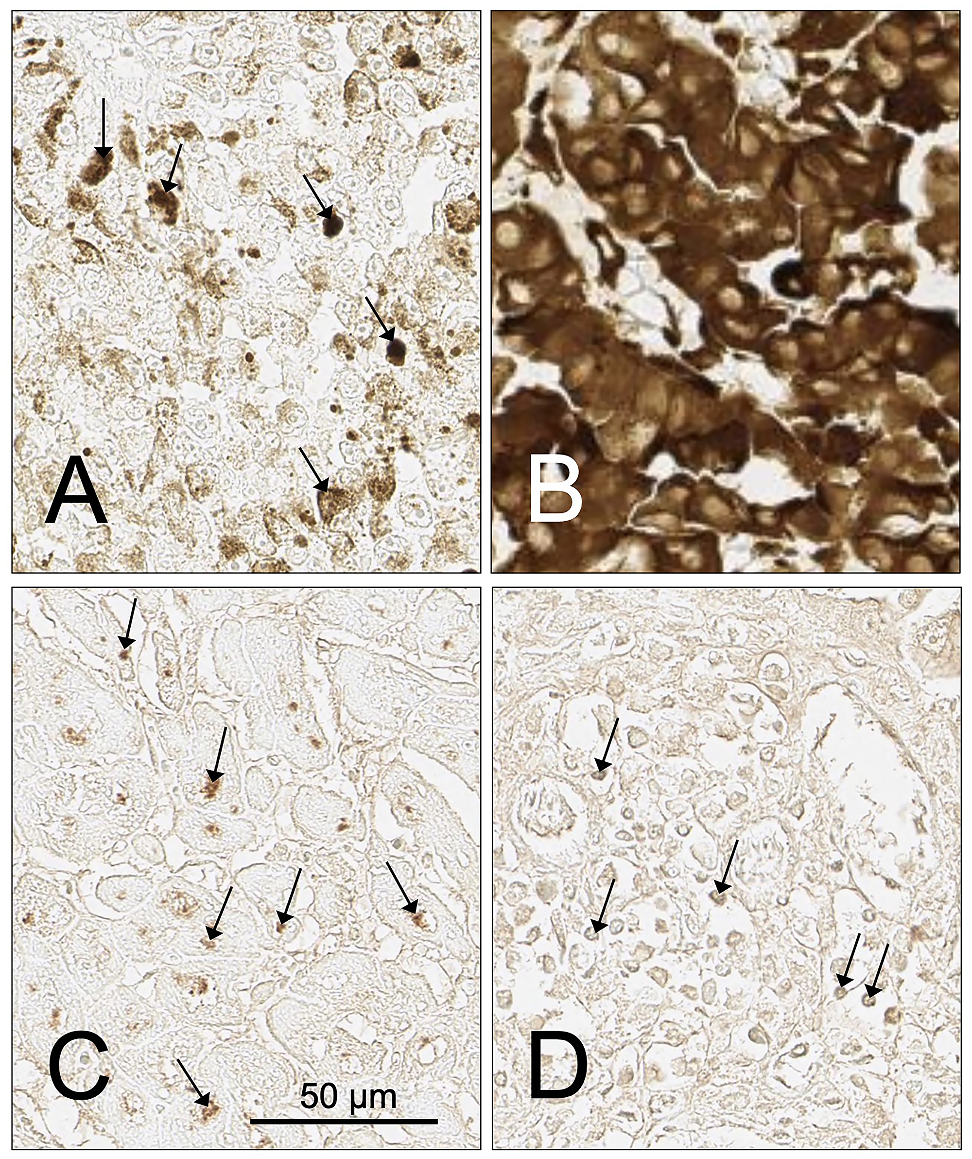 Examples of tumor cases with infiltrating lymphocytes or cells containing pigment that impact or prevent the assessment of SH7129 binding using DAB as a substrate