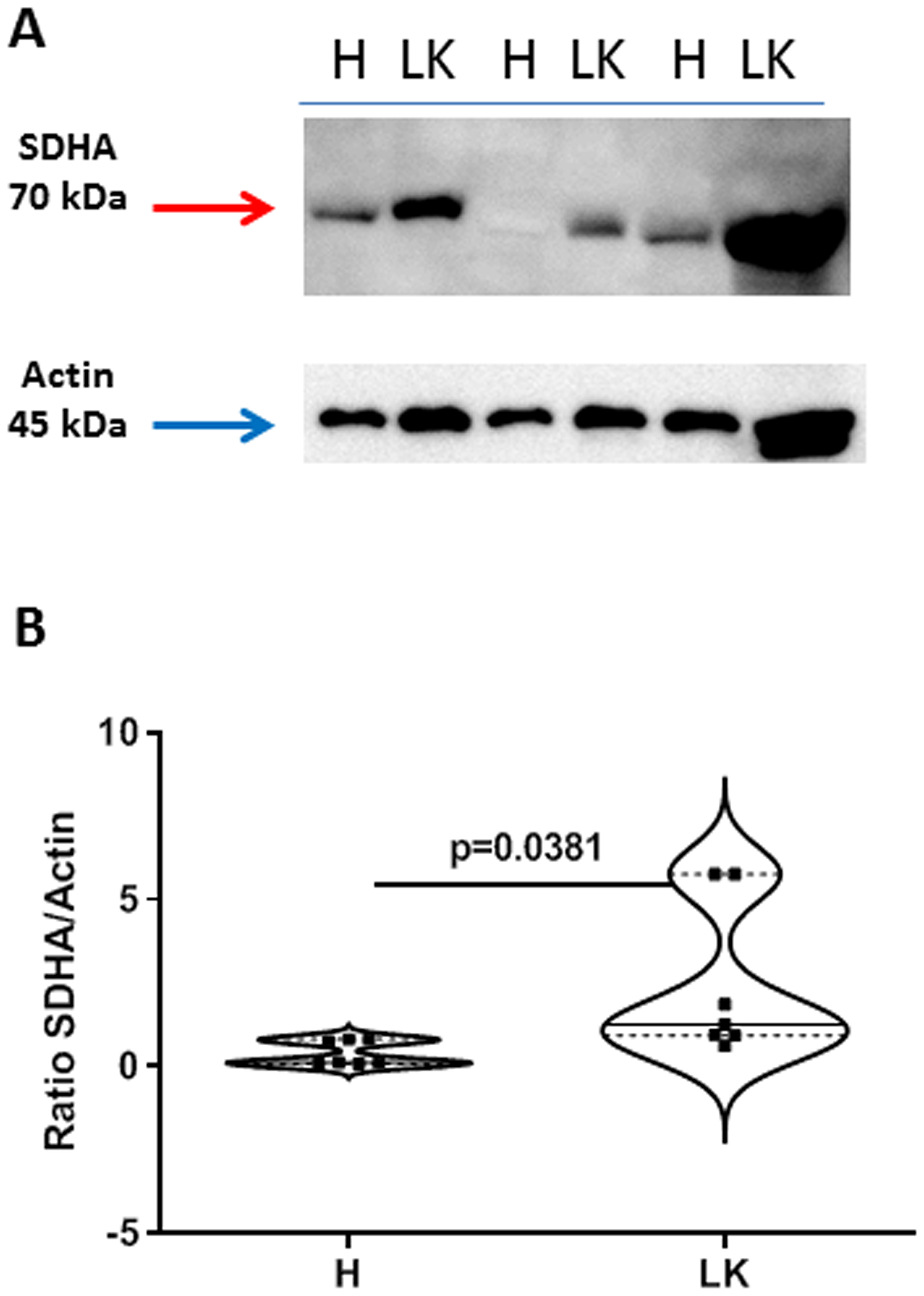Expression of succinate dehydrogenase (SDHA) in non-cancerous (H) and cancerous (LK) collagenase-digested NSCLC tissues