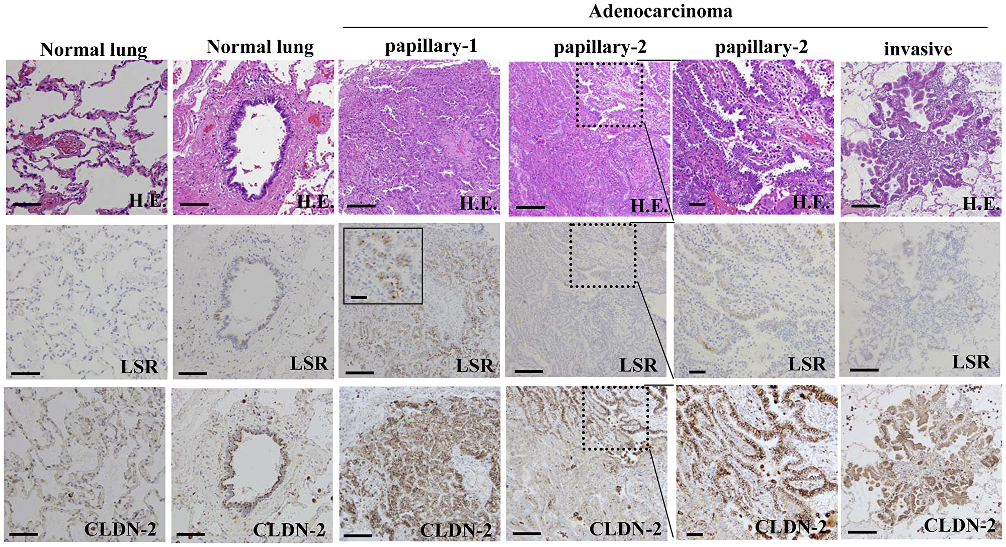 Expression and distribution of LSR and CLDN-2 in human lung adenocarcinoma