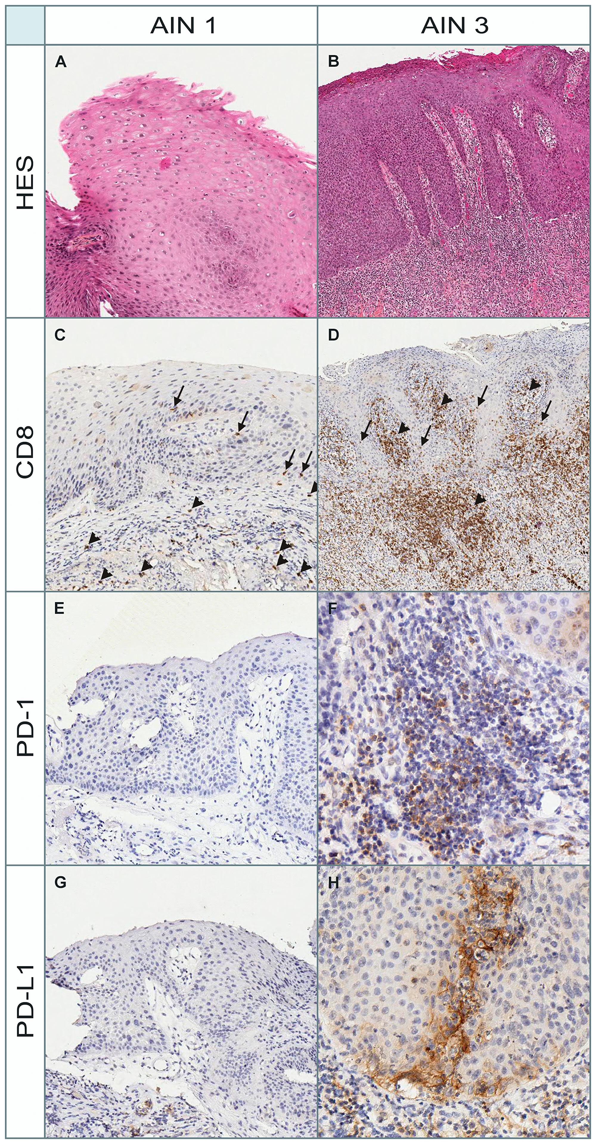 Morphological and immunohistochemical (PD-1, PD-L1, and CD8) aspects in a patient with AIN1 and AIN3