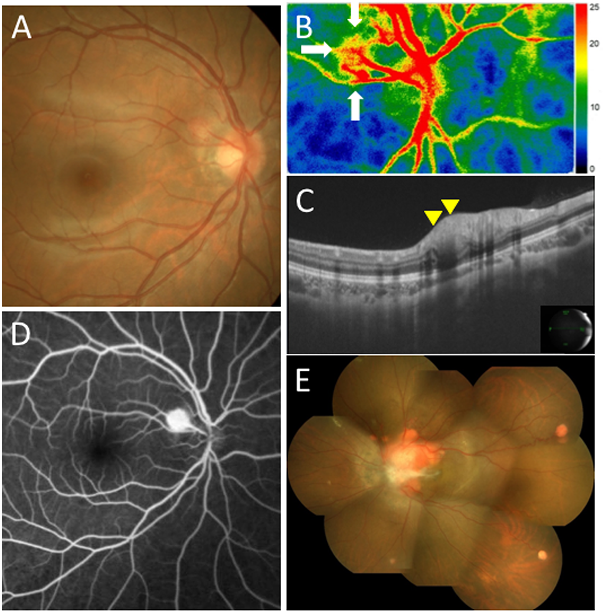 Initial findings on color fundus photography (CFP), swept-source optical coherence tomography (SS-OCT), laser speckle flowgraphy (LSFG), and fluorescein angiography (FA) in the present case with juxtapapillary retinal capillary hemangioblastoma (JRCH)