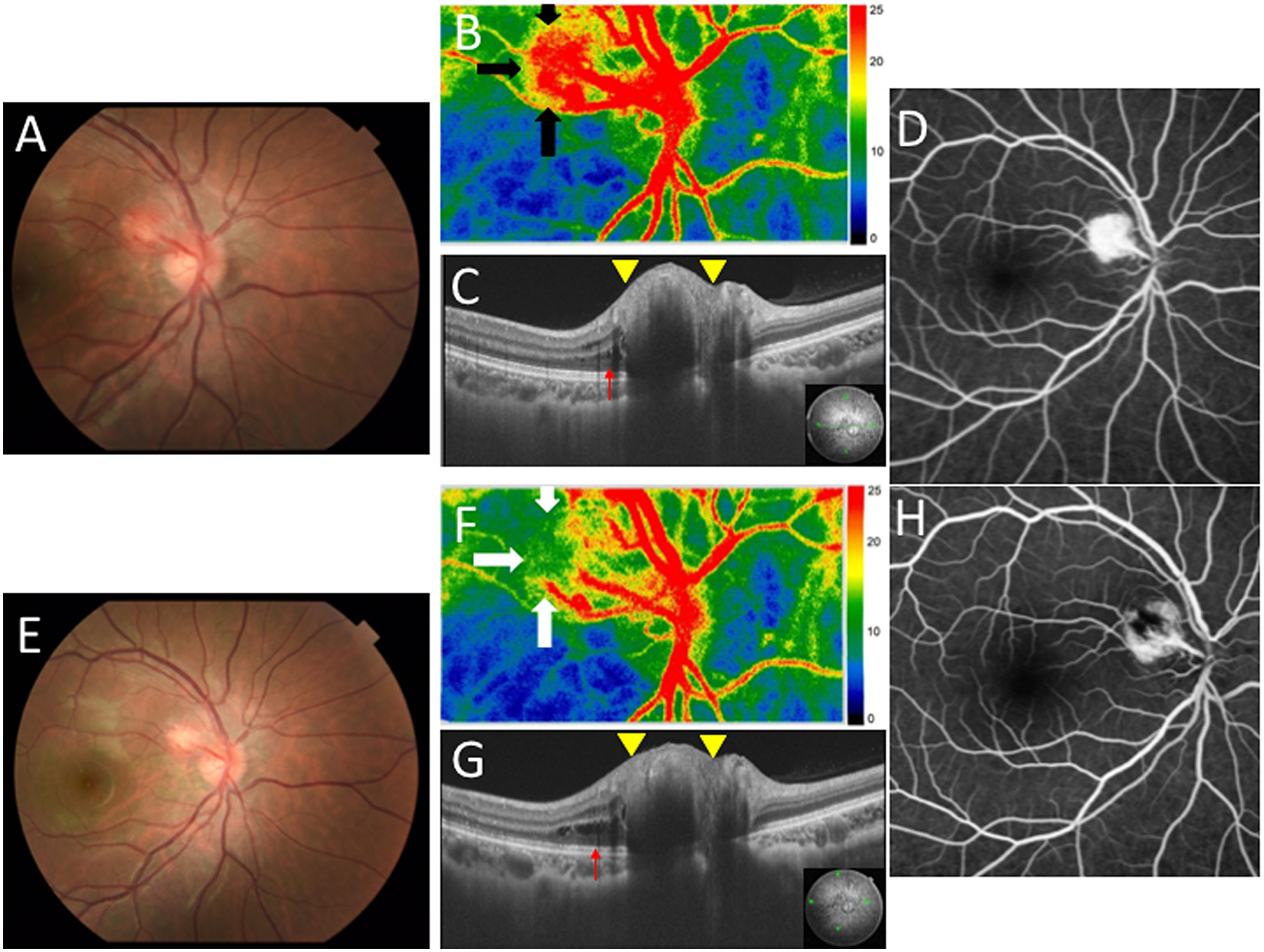Ophthalmic findings before and after laser photocoagulation (LPC) in the present case with JRCH in the right eye