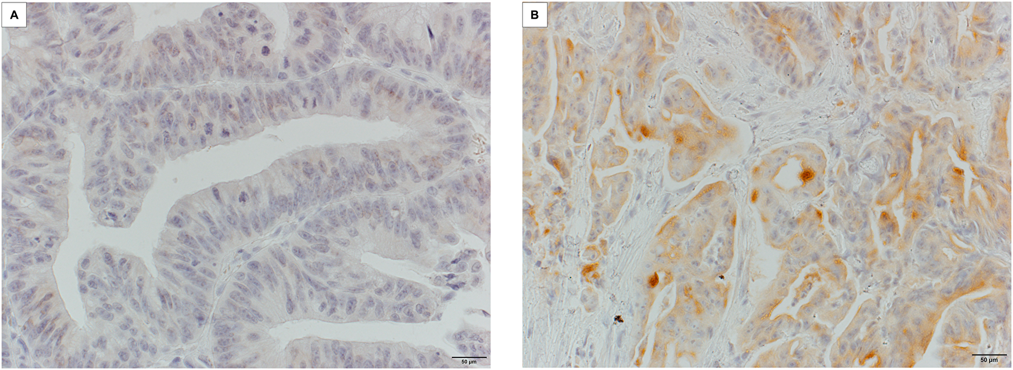 Microscopic appearance of MSLN expression in CRC tissue