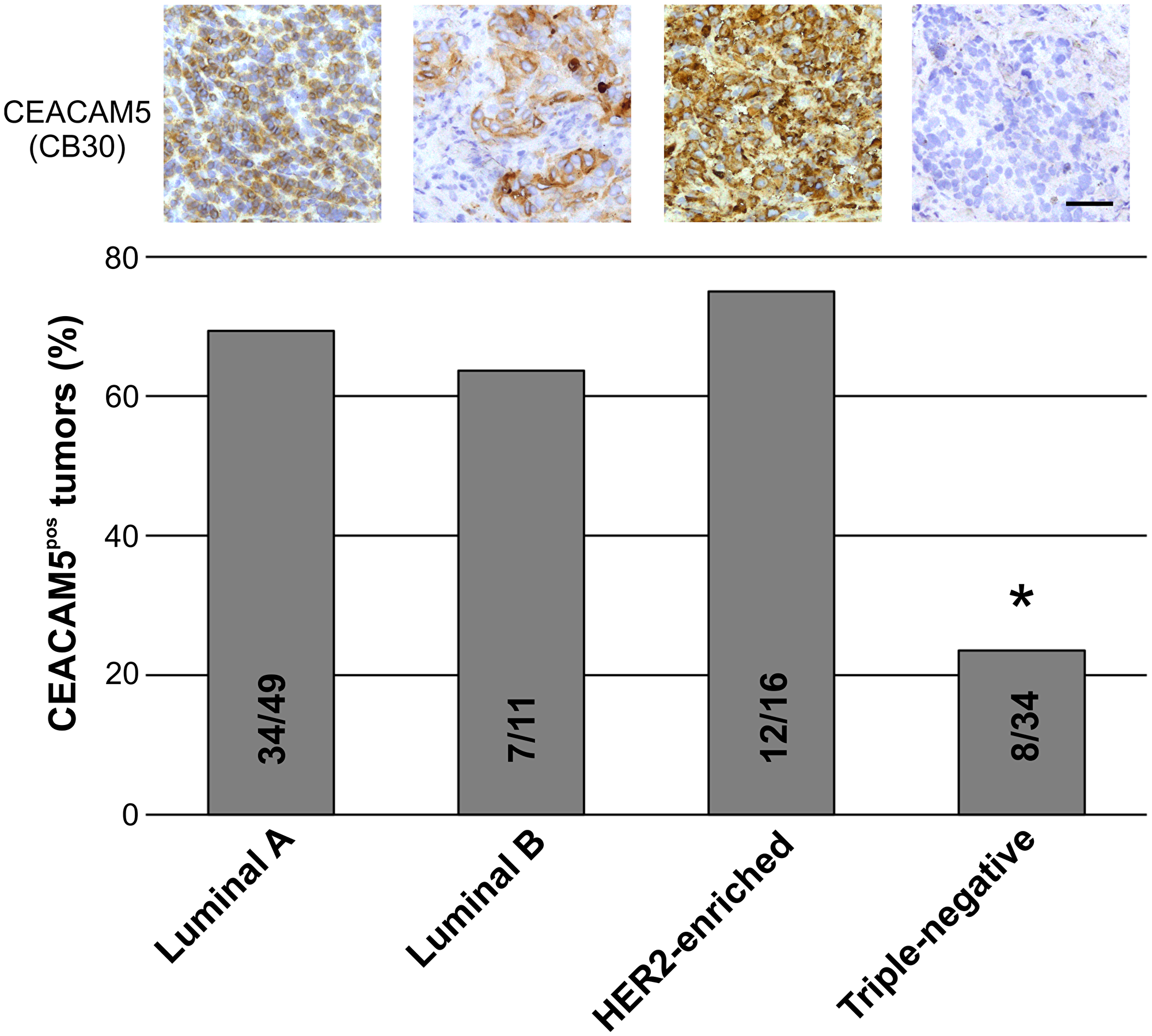 The proportion of CEACAM5-positive tumors are significantly higher in non-TN breast cancer subtypes