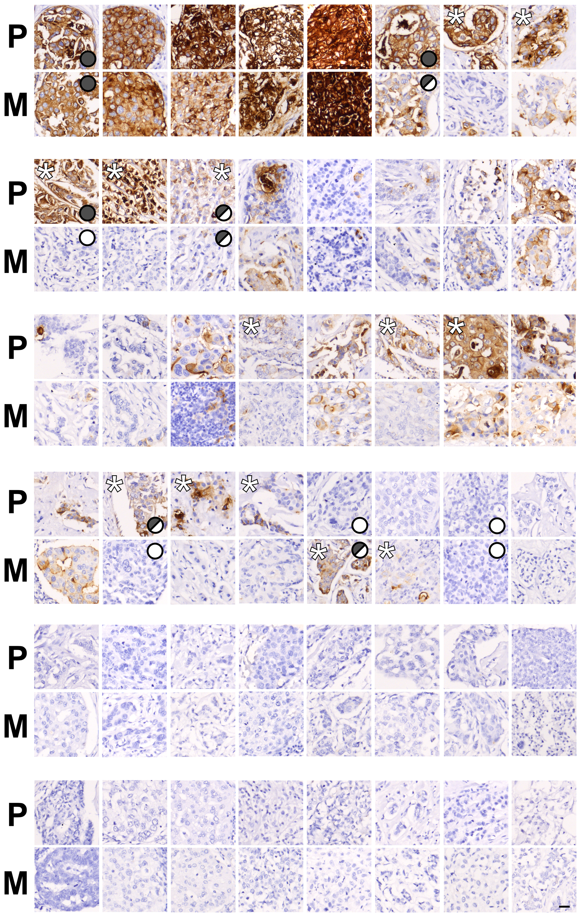 Pairs of primary breast cancer and lymph node metastases demonstrate different patterns of CEACAM5 expression