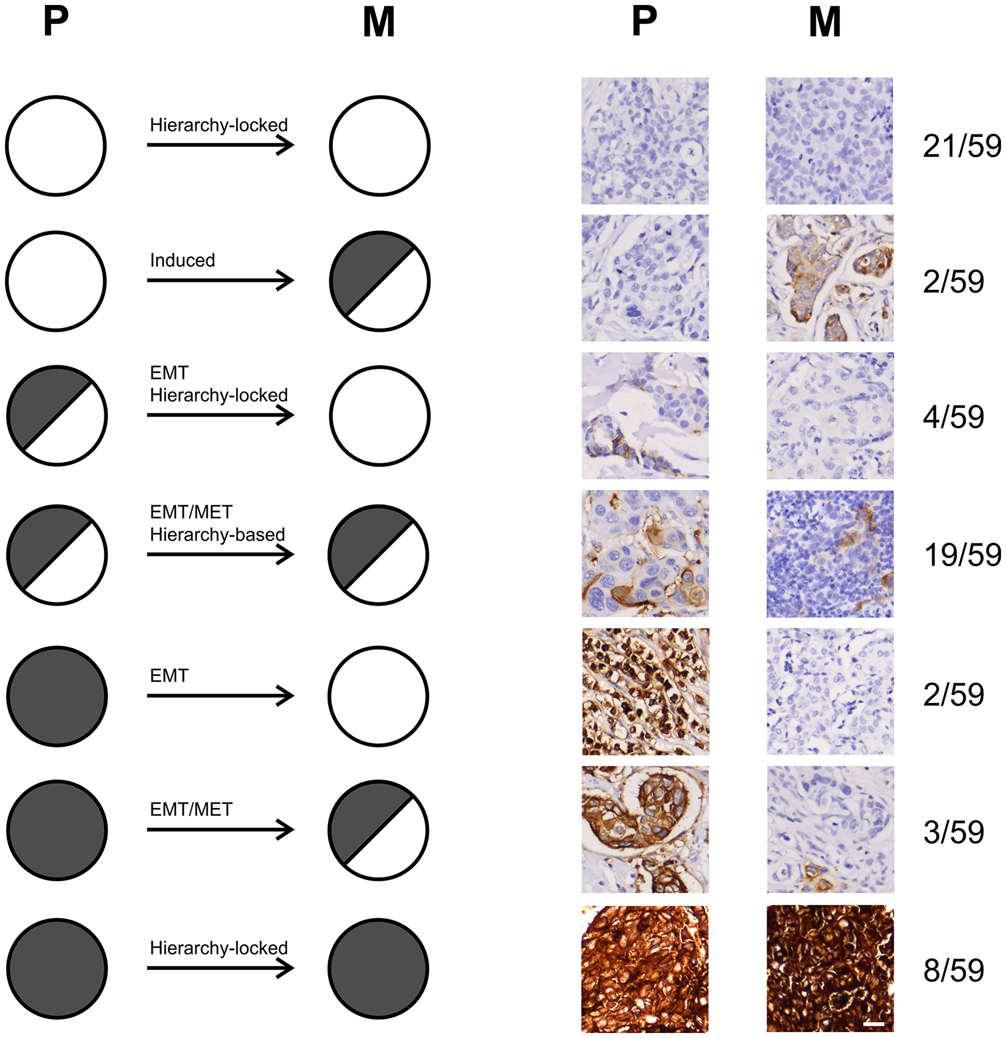 Proposed mechanisms of tumor dissemination from primary breast tumors to metastases