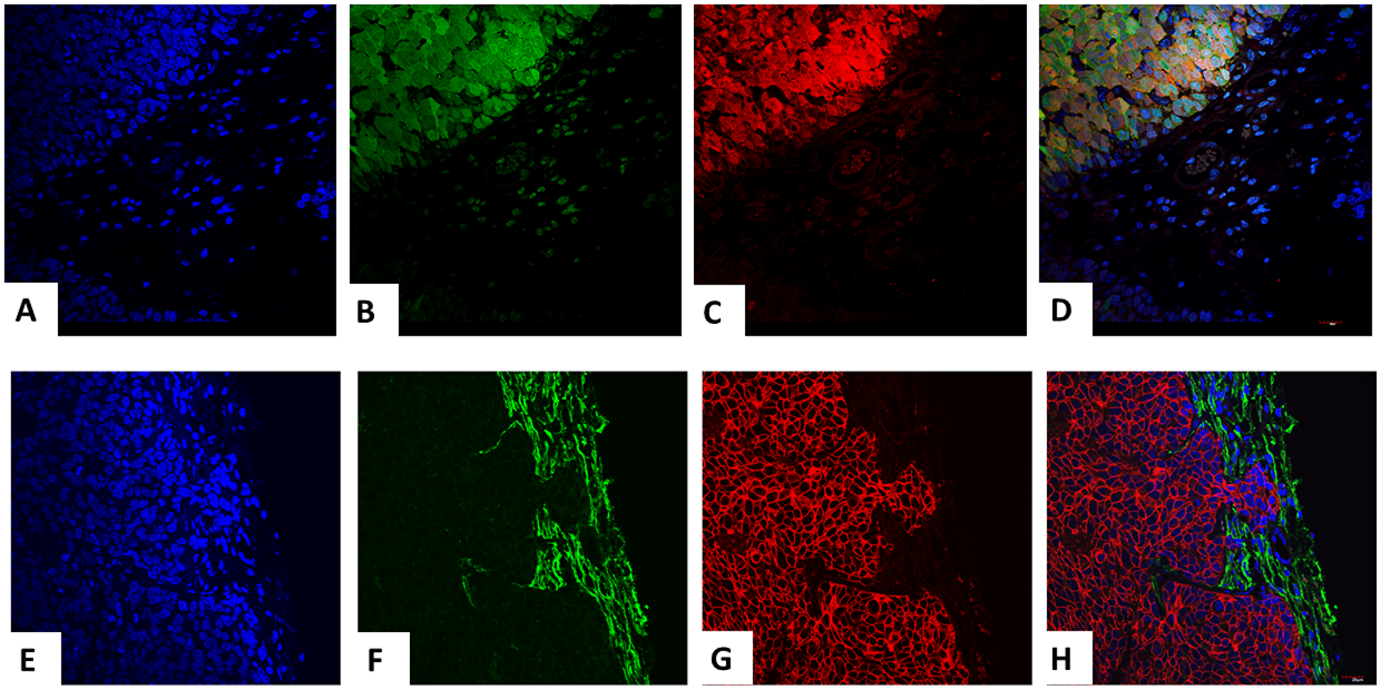 Trifluorescence studies of extirpated tumors in the transgenic-IPSC clones