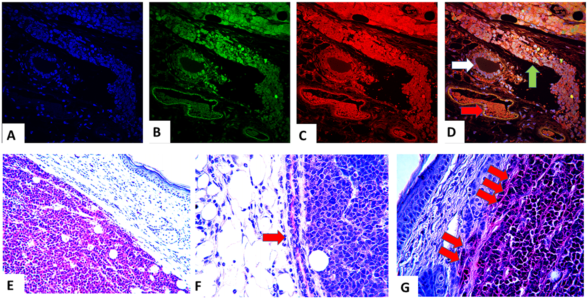 Trifluorescence studies of stages of oncogenesis in the PyVT-iPSC clones