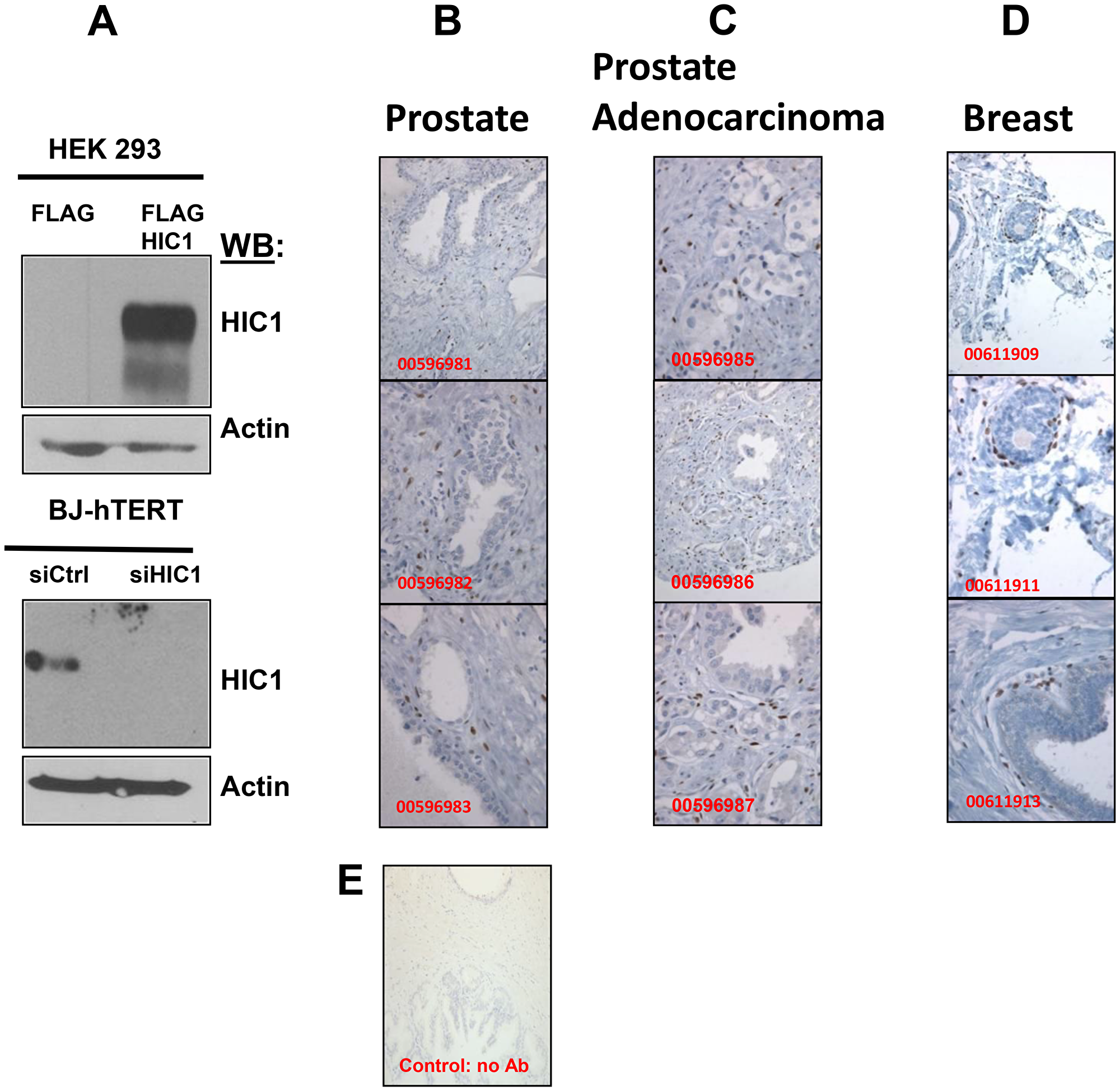 Immunohistochemical analyses of HIC1 expression in normal human prostate and breast tissues as well as in human PCa tissues
