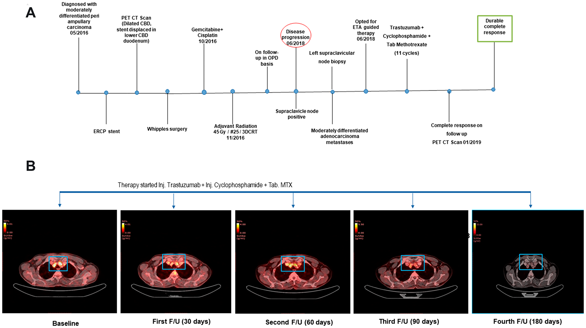 (A) The clinical timeline of the 55-year-old male diagnosed with distal CBD type of periampullary carcinoma. (B) Transverse sections of representative PET-CT scan images before treatment (Baseline) and after start of Cyclophosphamide + Methotrexate + Trastuzumab regimen depicted complete response.