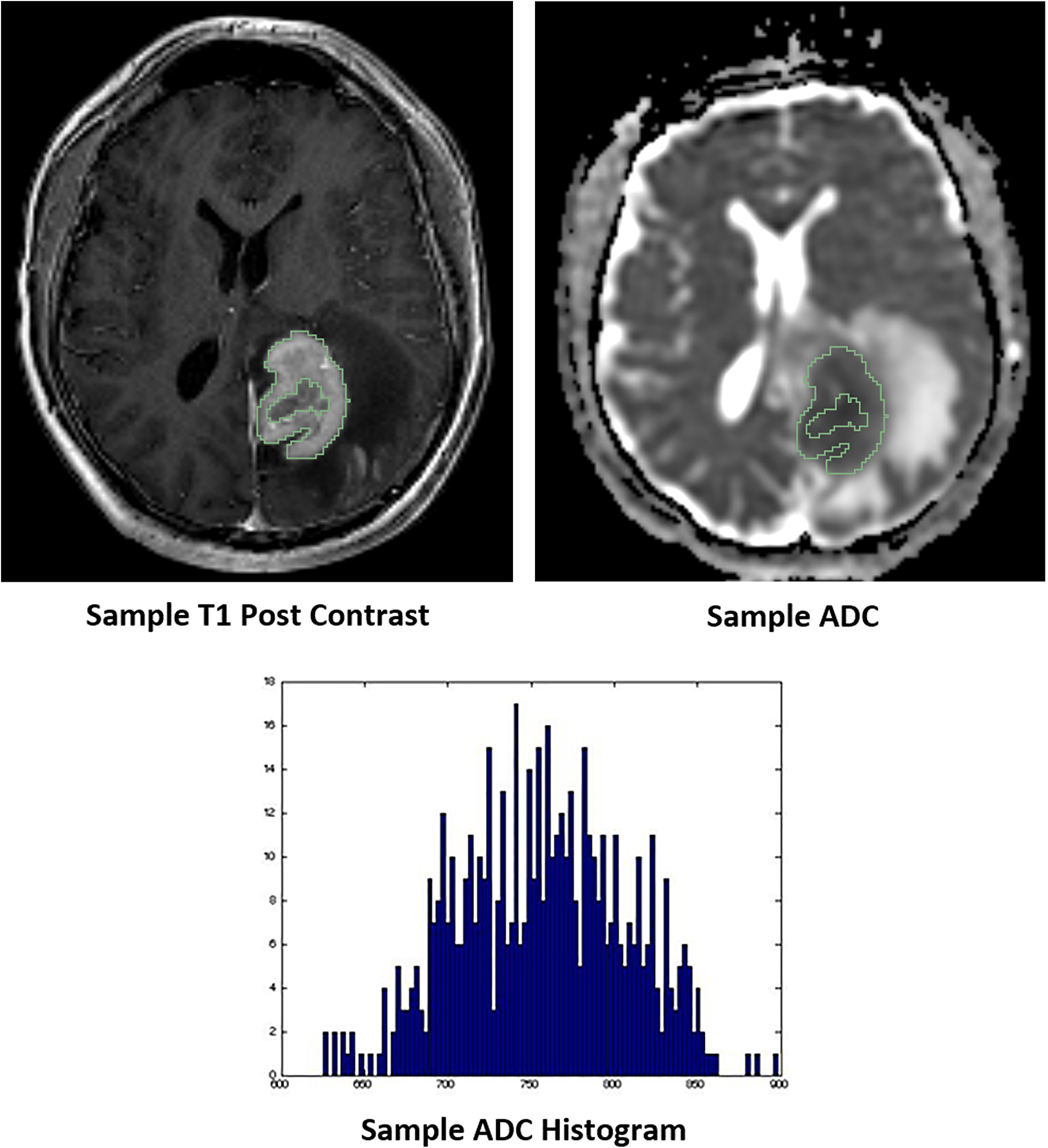 Representative images of whole tumor volume segmentation of the co-registered T1 post-contrast sequence and apparent diffusion coefficient (ADC) map, yielding the corresponding ADC histogram distribution utilized for data analysis