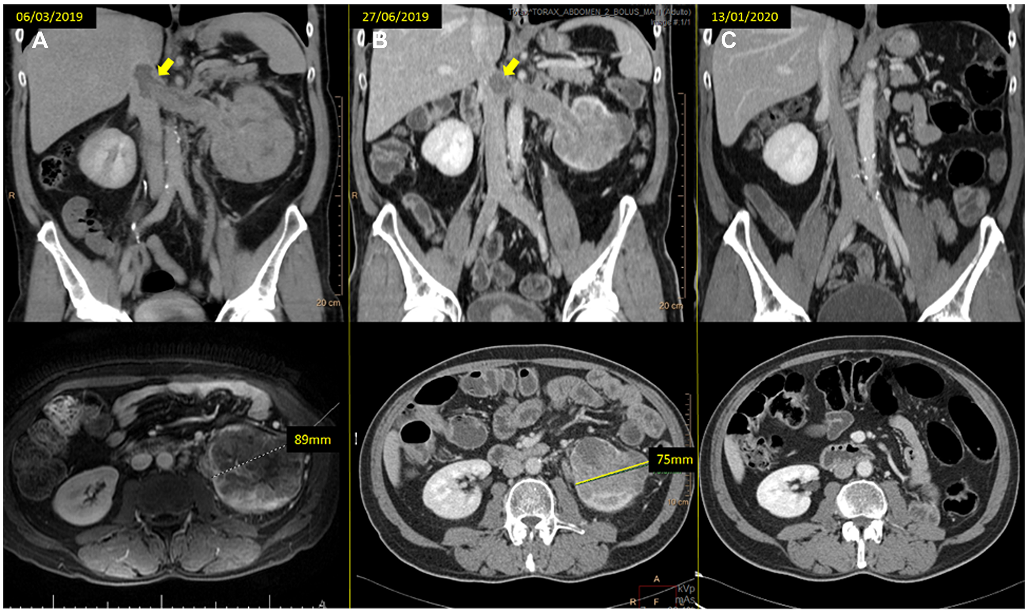 (A) baseline CT scan and (B) the reassessment CT scan at 12 weeks of treatment, showing the tumor thrombus downsizing (arrows) and the left kidney mass response (from 89 to 75 mm). (C) last reassessment CT scan where the patient remains progression free.