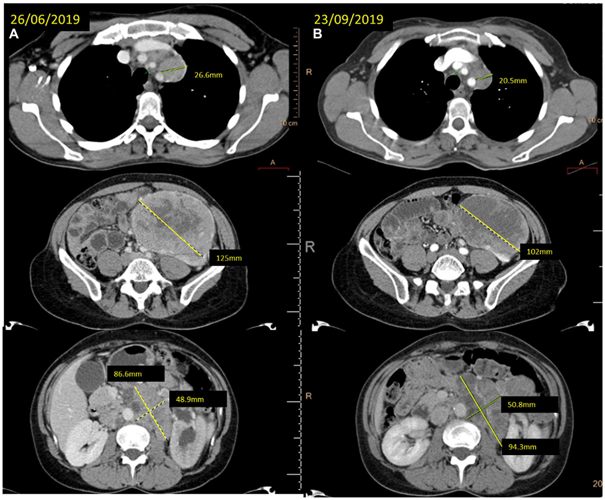 (A) baseline CT scan and (B) the reassessment CT scan showing the response achieved after 12 weeks of treatment with cabozantinib at different levels (mediastinal lymph nodes, left kidney mass and retroperitoneal lymph nodes).