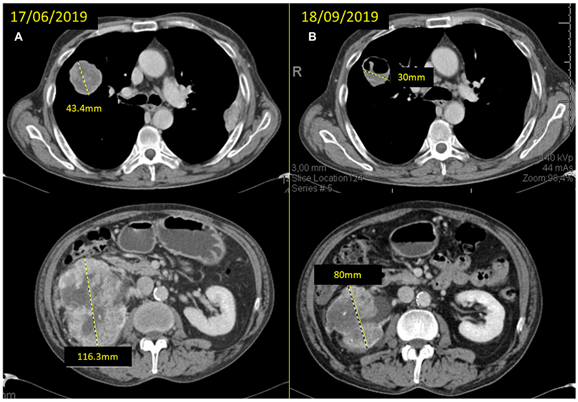 (A) baseline CT scan and (B) response after 12 weeks of neoadjuvant treatment with cabozantinib with significant reduction of the mass in the superior right lobe (SRL) from 43.4 to 30 mm and of the right kidney mass from 116.3 to 80 mm.