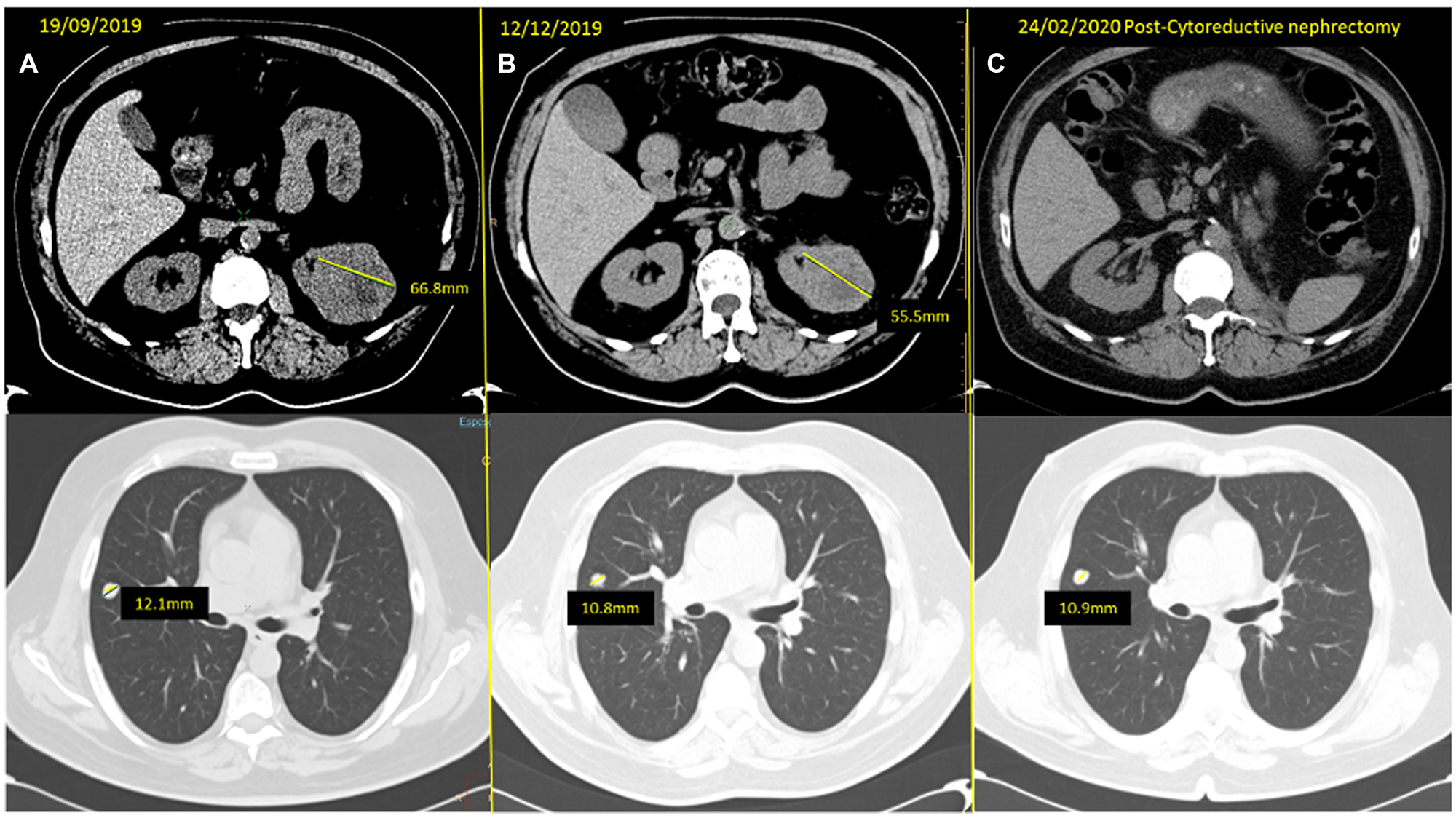 (A) baseline CT scan and (B) response obtained after three months of neoadjuvant cabozantinib, with a reduction of the left kidney mass from 66.8 to 55.5 mm and of the SRL nodule from 12.1 to 10.8 mm. (C) Last reassessment CT scan, after CN, showing only stability of the remaining solitary lung metastases which is pending surgery.