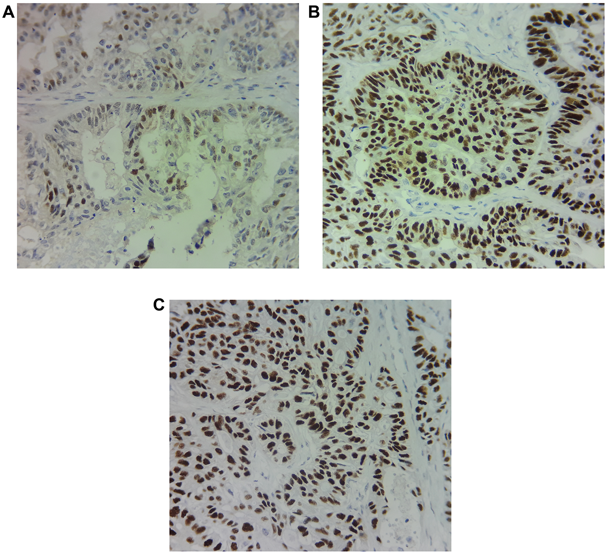 Immunohistochemical staining of (A) Androgen receptor (AR), (B) Estrogen receptor (ER) and (C) progesterone receptor (PR) shows 30%, 90% and 80% of expression respectively in the primary tumor cells.