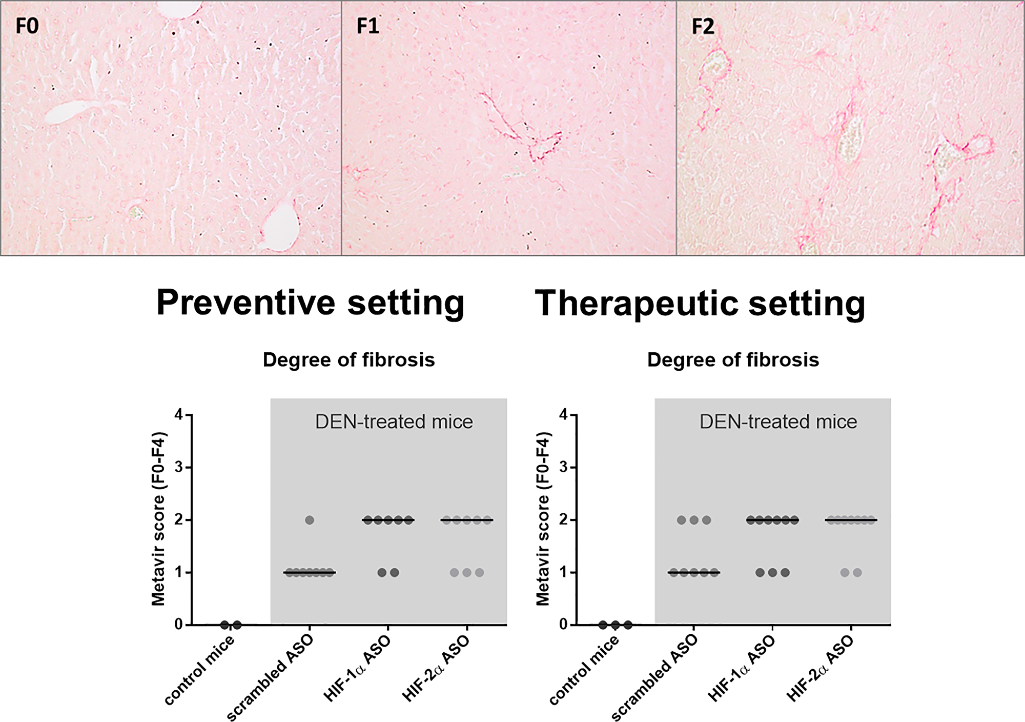 Effect of preventive and therapeutic HIF-1α and HIF-2α ASO treatment on liver fibrosis in DEN-induced HCC mice