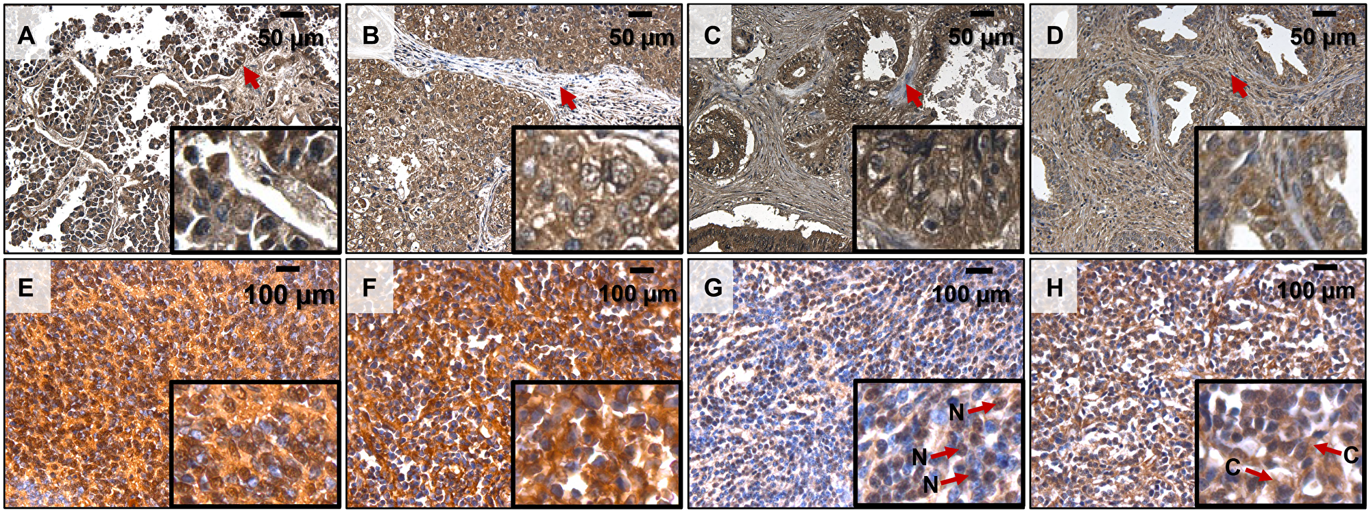 PolyP detection by immunohistochemistry in human cancer samples