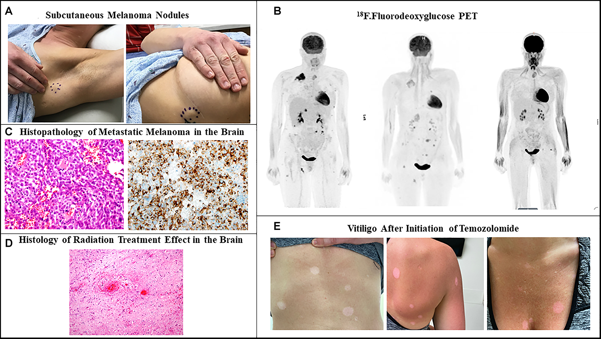Recurrent metastatic melanoma