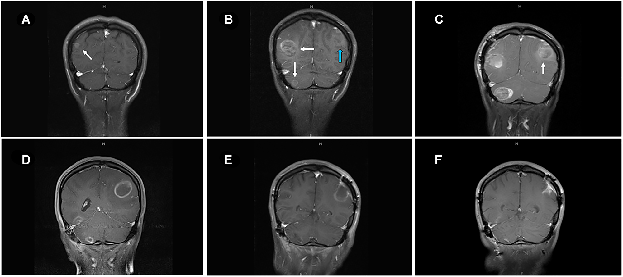 MRI of brain of metastatic lesions showing (A) coronal section demonstrating right parieto-occipital lesion at the start of ipilimumab-nivolumab (arrow). (B) coronal image showing right parieto-occipital and right cerebellar lesions (white arrows) and left posterior parietal lesion (blue arrow) after three cycles of ipilimumab-nivolumab. (C) Post-surgical resection of two symptomatic lesions- right parieto-occipital and right cerebellar lesions with persistent left posterior parietal lesion (arrow). (D) Enlarging left posterior parietal lesion post TVEC and pembrolizumab. (E) Surgical cavity after resection of left posterior parietal lesion and one month after TMZ treatment. (F) Collapsing surgical cavity of left posterior parietal lesion resection with no evidence of recurrent disease in the brain after 19 months of temozolomide initiation.