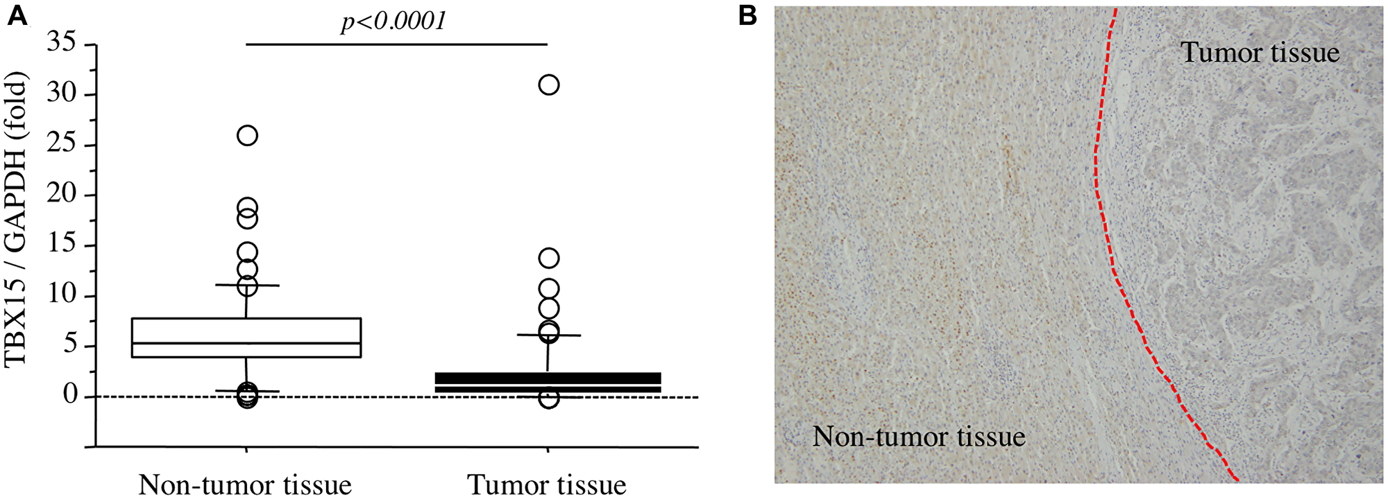 (A) TBX15 mRNA expression in tumor tissues and nontumor tissues. (B) TBX15 protein expression in tumor tissues and nontumor tissues.