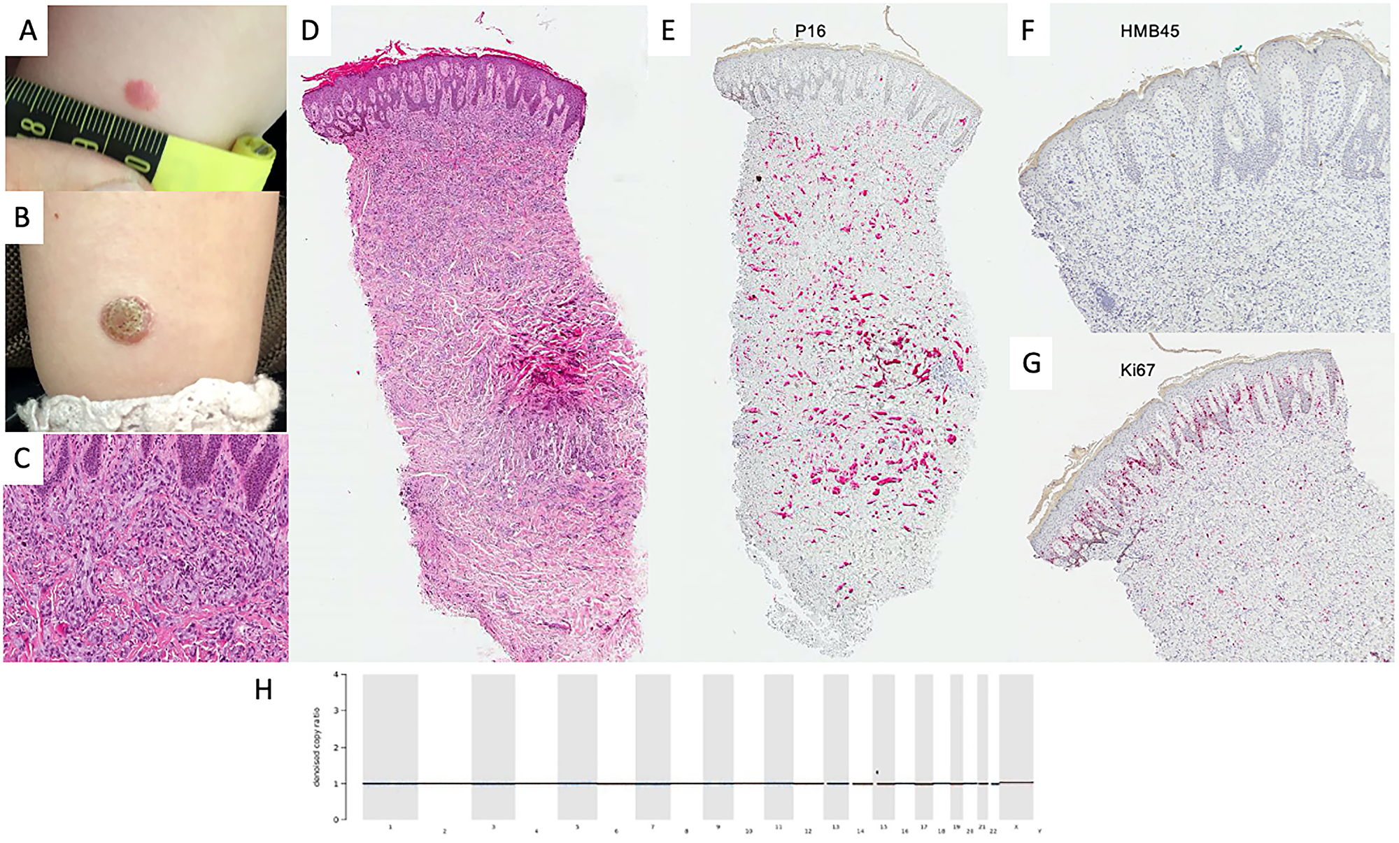 Diagnostics in benign spitzoid lesion