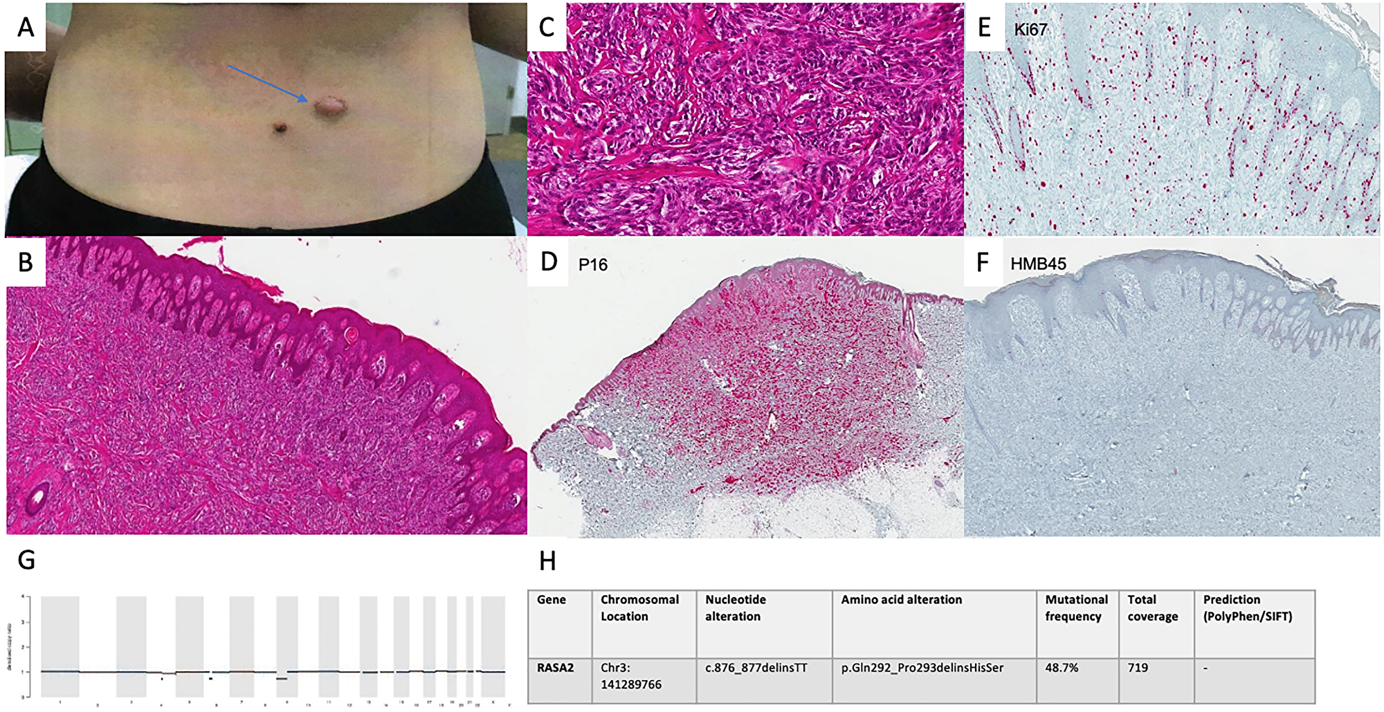 Diagnostics in intermediate spitzoid lesion
