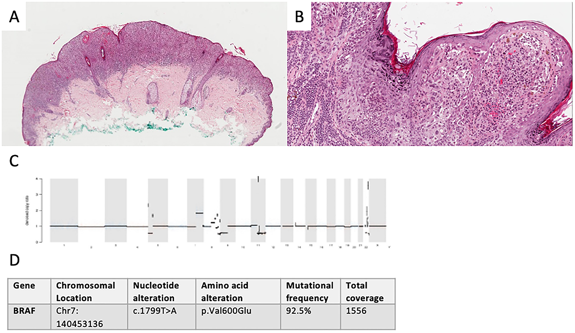 Diagnostics in malignant spitzoid lesion