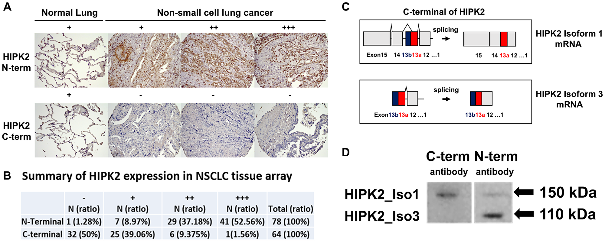 Immunohistochemistry of HIPK2 in NSCLC tissue array and detection of two different HIPK2 isoforms (110 kDa and 150 kDa) in NSCLC cell line H1975