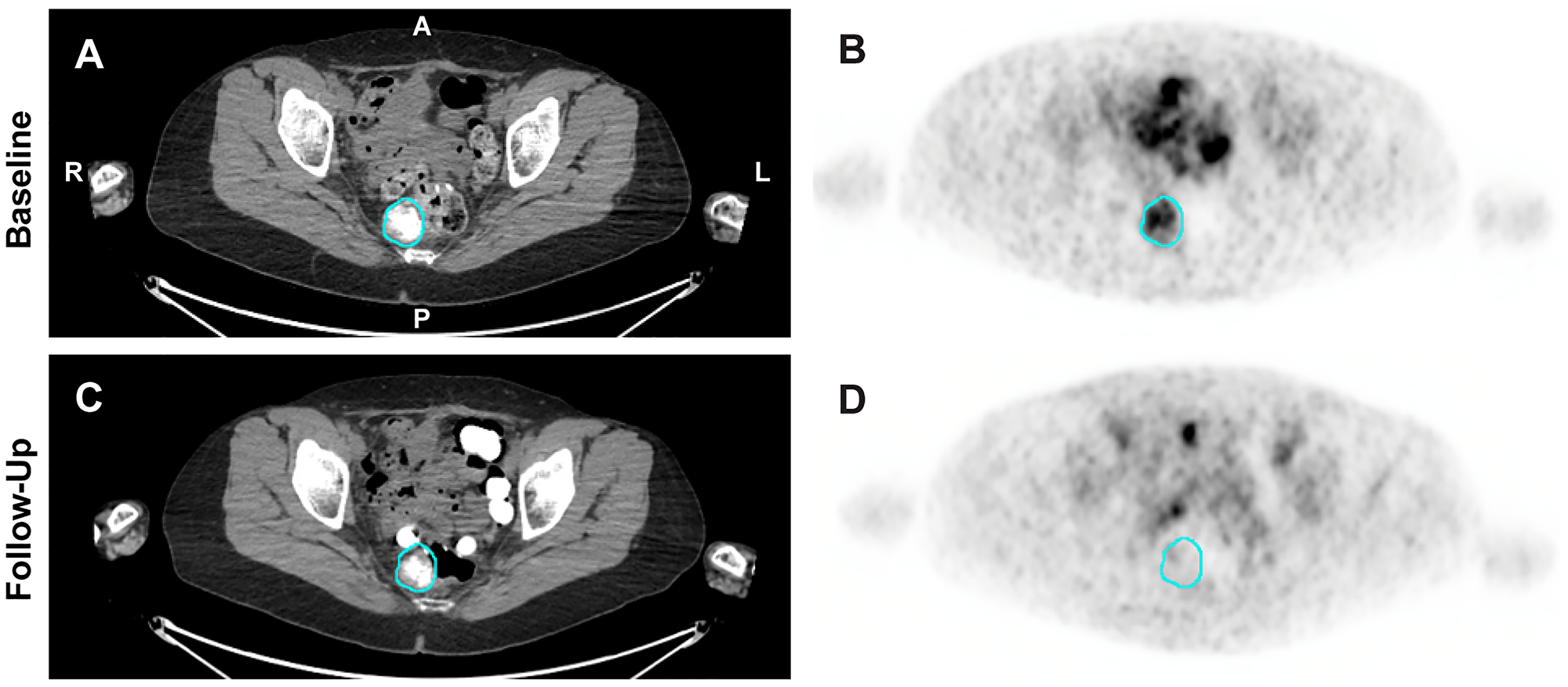 18F-FES PET/CT images from patient 40 with serous ovarian cancer