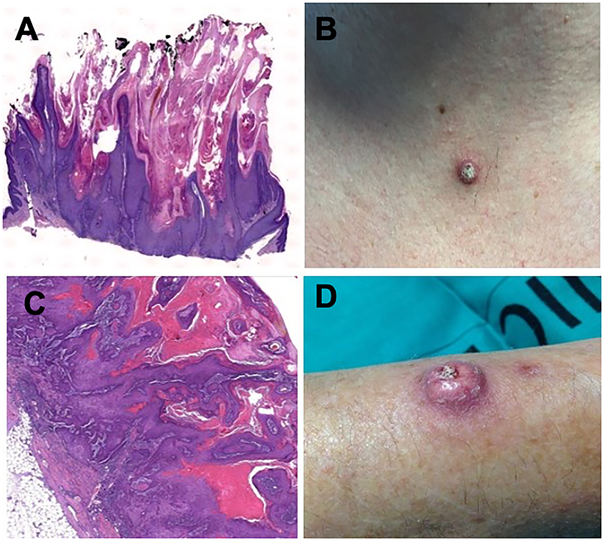 Histologic findings in hematoxylin and eosin staining 2x magnification (A) and clinical aspect (B) of a keratoacanthoma in a patient under sorafenib treatment. Histologic findings in hematoxylin and eosin staining 2x magnification (C) and clinical aspect (D) of a squamous-cell carcinoma in a patient under sorafenib treatment.