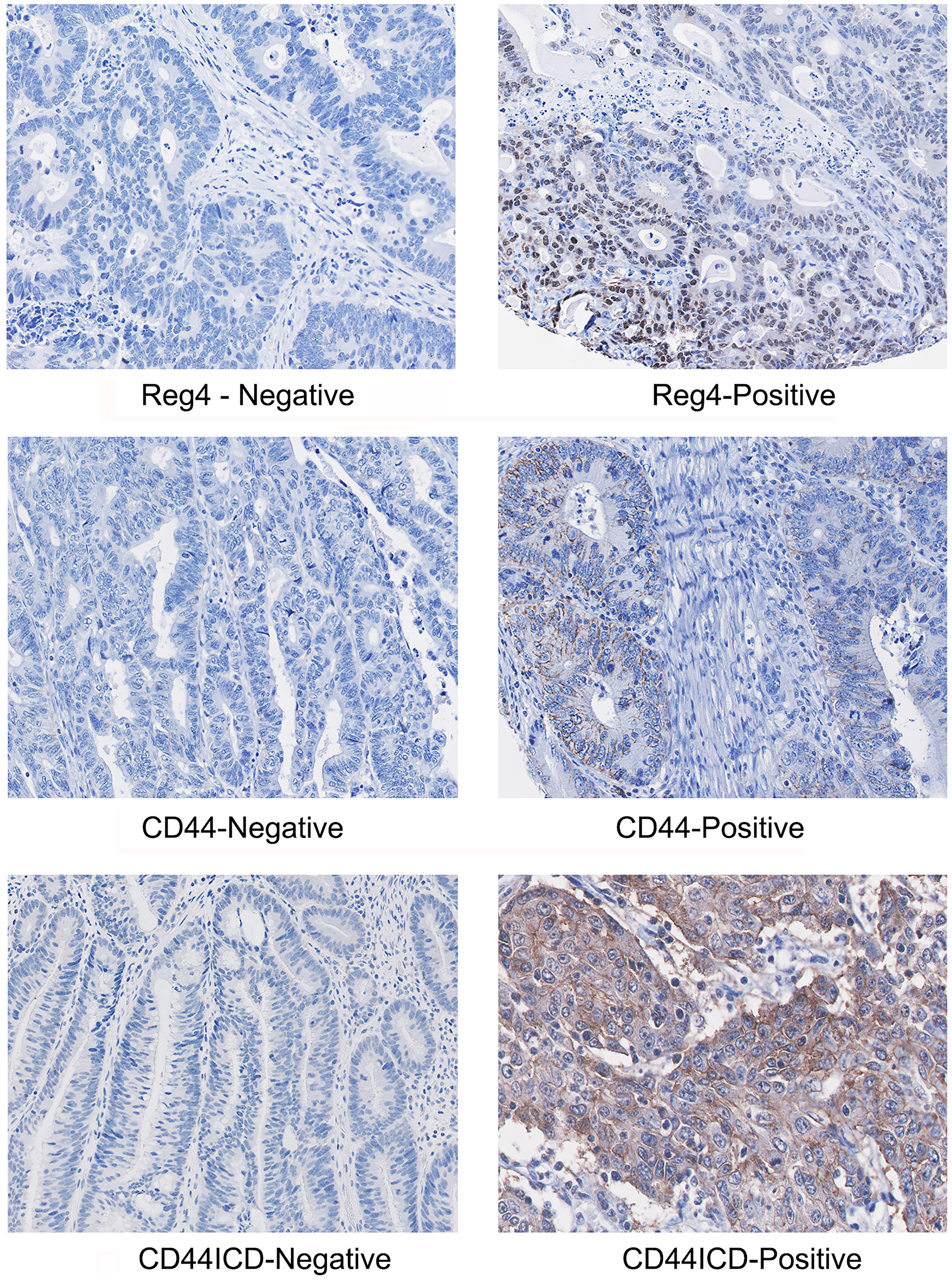 A representative immunostaining expression of Reg4, CD44 and CD44ICD proteins in CRC TMA core showing representative positive and negative samples