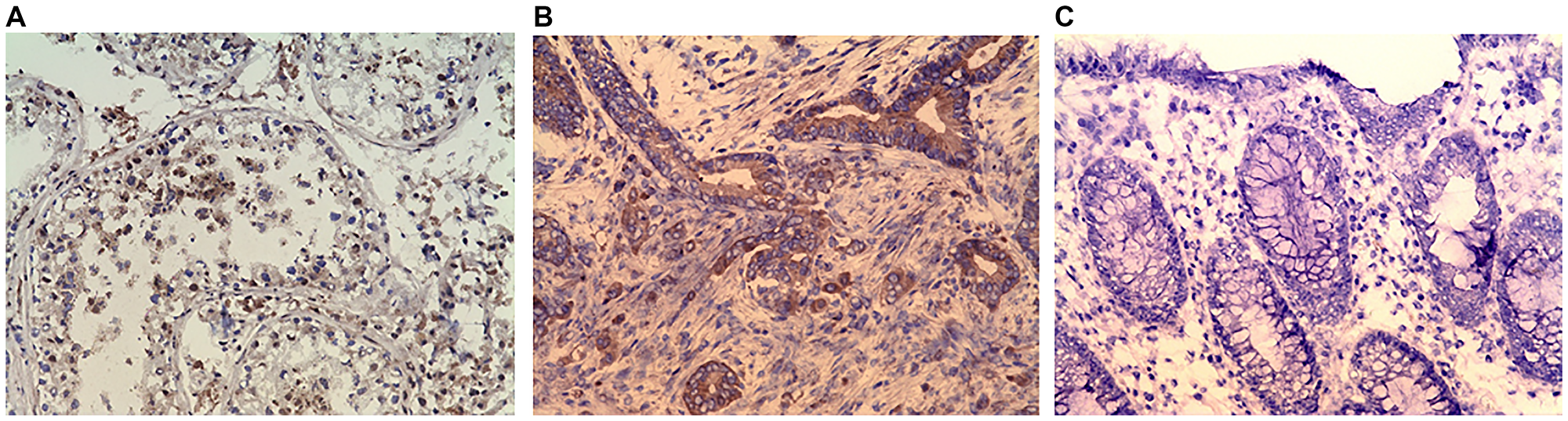 (A) Immunohistochemistry (IHC) staining of testis (positive control). (B) IHC staining of colonic adenocarcinoma. (C) IHC stating of Normal colonic mucosa (negative control). Purified rabbit anti-human CABYR polyclonal antibody for CABYR a/b and c antigen isoforms were used in IHC.