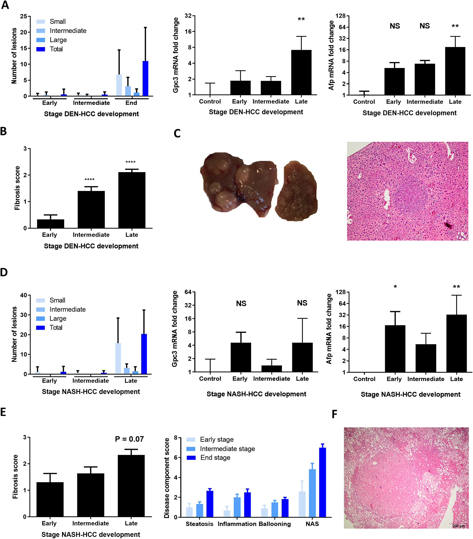 Clinicopathological features of DEN and NASH-induced HCC development