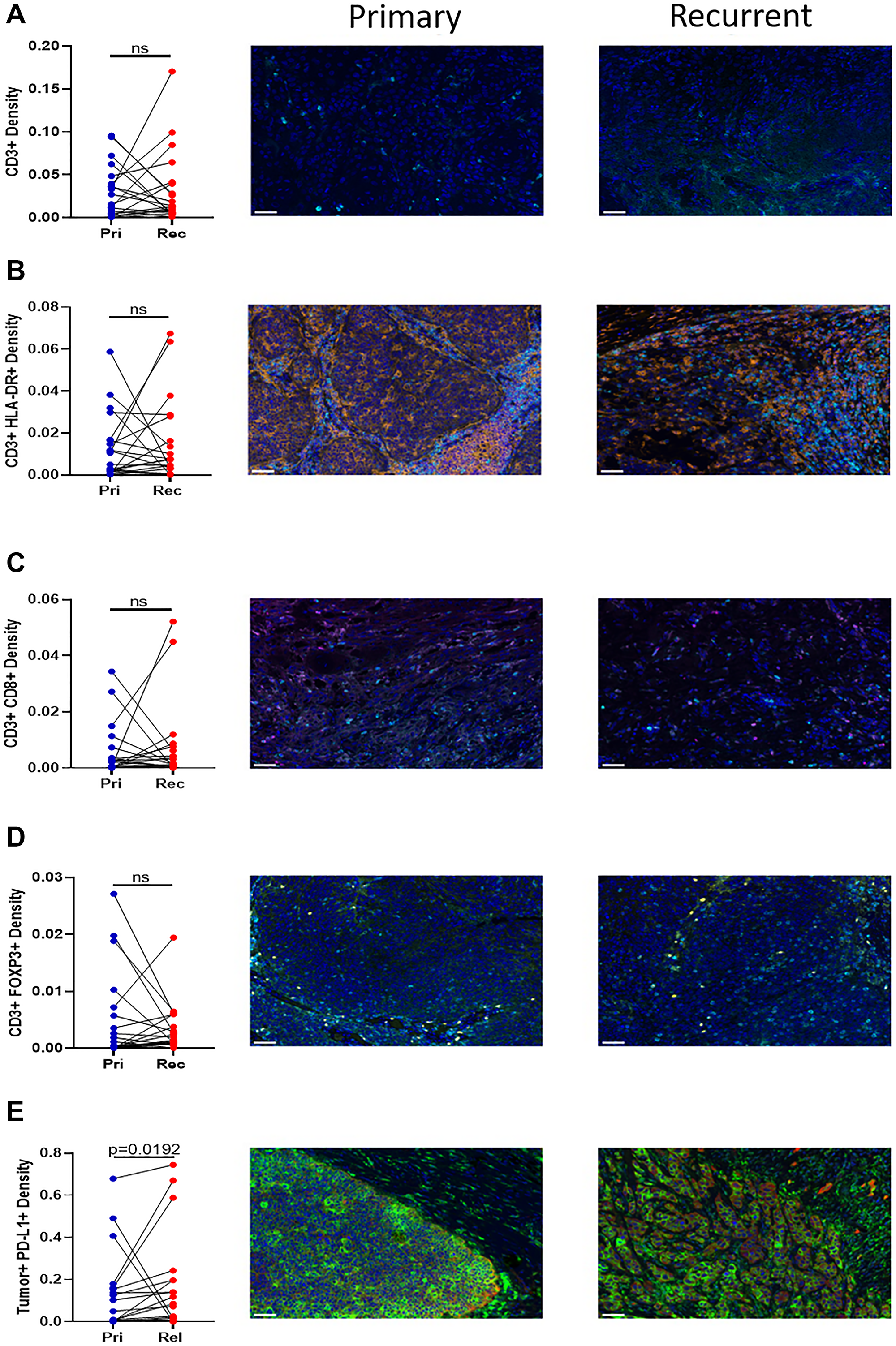 Immunohistochemistry of T cell infiltration into the tumor