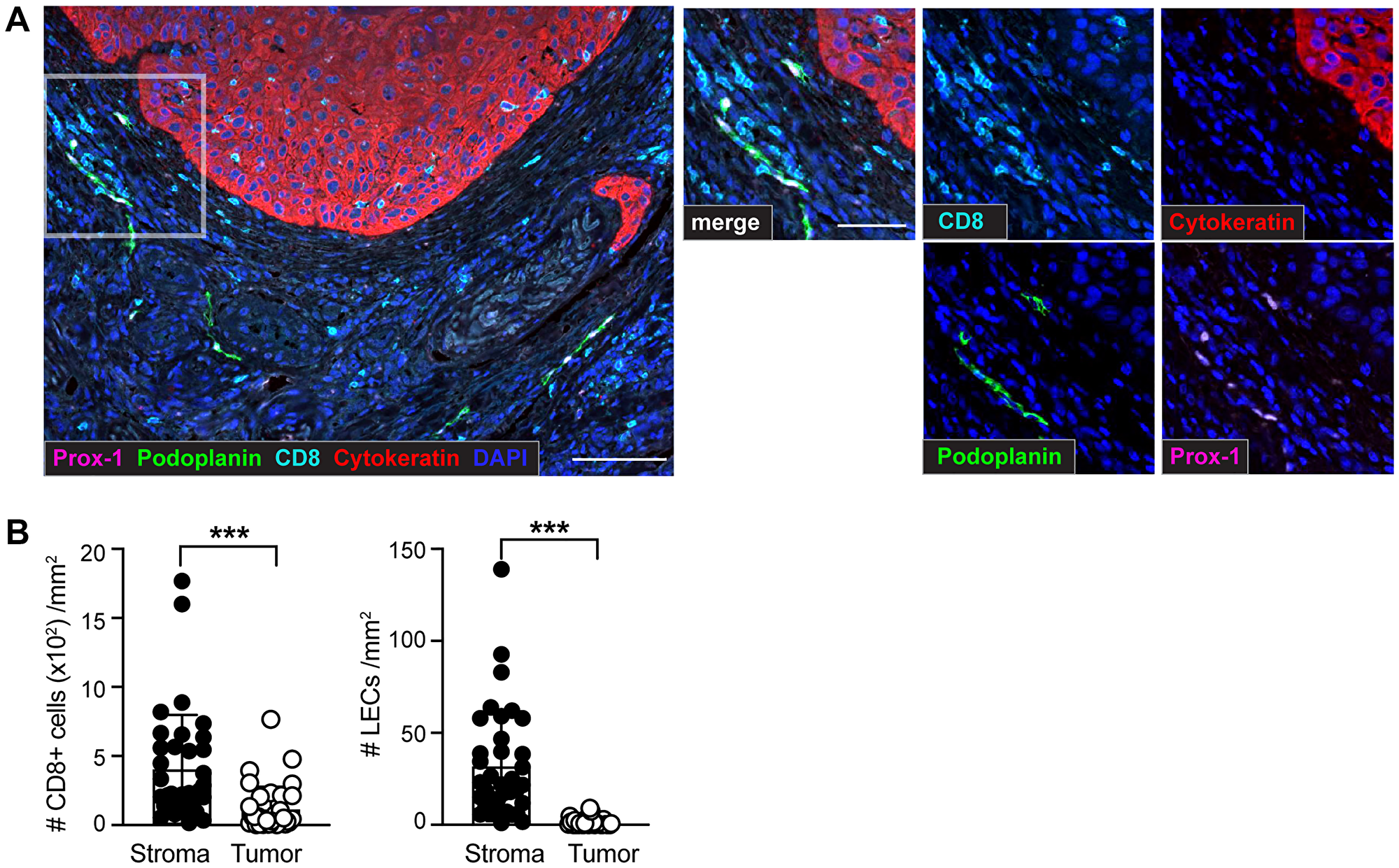 Identification of CD8+ T cells and lymphatic endothelial cells (LECs) within the tumor microenvironment (TME) of sSCC sections using multiplex immunohistochemistry (IHC)
