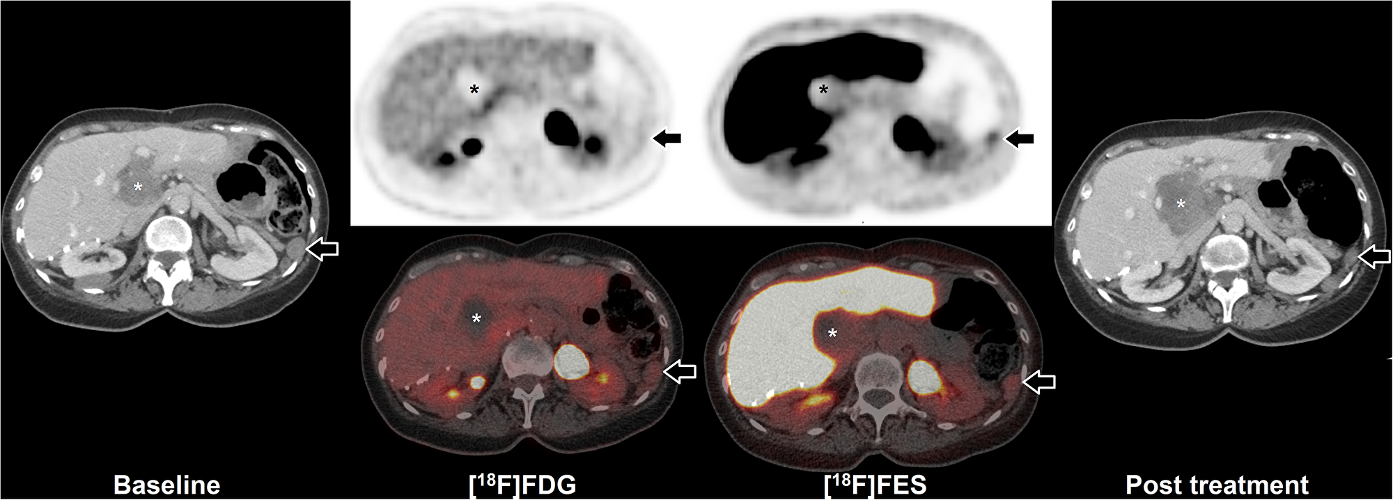 FES-PET and response to hormone treatment
